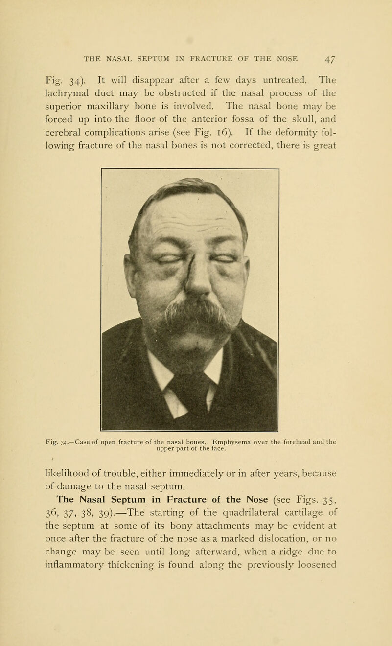 Fig. 34). It will disappear after a few days untreated. The lachrymal duct may be obstructed if the nasal process of the superior maxillary bone is involved. The nasal bone may be forced up into the floor of the anterior fossa of the skull, and cerebral complications arise (see Fig. 16). If the deformity fol- lowing fracture of the nasal bones is not corrected, there is great Fig. 34.—Case of open fracture of the nasal bones. Emphysema over the forehead and the upper part of the face. likelihood of trouble, either immediately or in after years, because of damage to the nasal septum. The Nasal Septum in Fracture of the Nose (see Figs. 35, 3^, 37» 38, 39)-—The starting of the quadrilateral cartilage of the septum at some of its bony attachments may be evident at once after the fracture of the nose as a marked dislocation, or no change may be seen until long afterward, when a ridge due to inflammatory thickening is found along the previously loosened