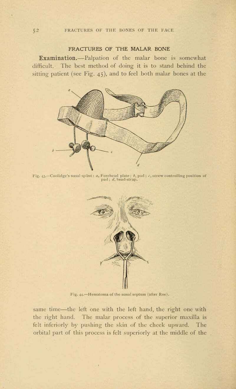 FRACTURES OF THE MALAR BONE Examination.—Palpation of the malar bone is somewhat difficult. The best method of doing it is to stand behind the sitting patient (see Fig. 45), and to feel both malar bones at the F'g- 43-—Coolidge's nasal splint: a, Forehead plate; b, pad ; c, screw controlling position of pad ; d, head-strap. Fig. 44.—Hematoma of the nasal septum (after Roe). same time—the left one with the left hand, the right one with the right hand. The malar process of the superior maxilla is felt inferior]}- by pushing the skin of the check upward. The orbital part of this process is felt superiorly at the middle of the