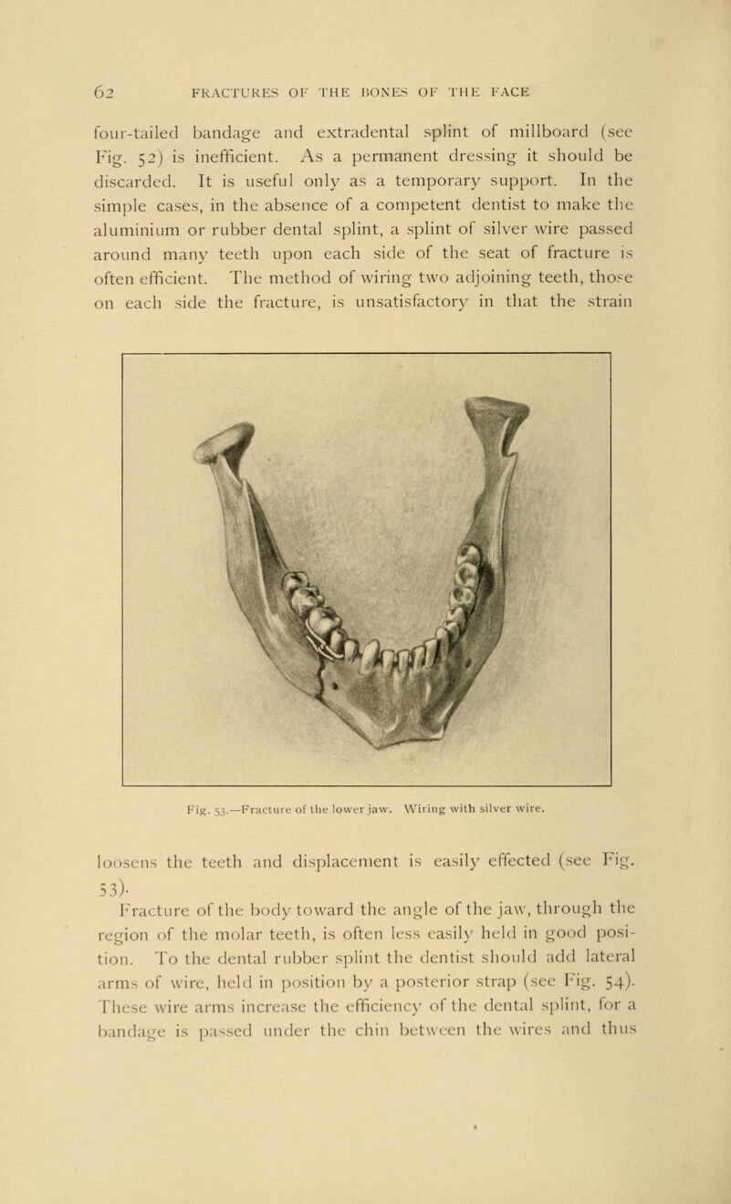 four-tailed bandage and extradental splint of millboard (see Fig. 52) is inefficient. As a permanent dressing it should be discarded. It is useful only as a temporary support. In the simple cases, in the absence of a competent dentist to make the aluminium or rubber dental splint, a splint of silver wire passed around many teeth upon each side of the seat of fracture is often efficient. The method of wiring two adjoining teeth, those on each side the fracture, is unsatisfactory in that the strain Fig. 53.—Fracture of the lower jaw. Wiring with silver wire. loosens the teeth and displacement is easily effected (sec Fig. 53)- Fracture of the body toward the angle of the jaw, through the region of the molar teeth, is often less easily held in good posi- tion. To the dental rubber splint the dentist should add lateral arms of wire, held in position by a posterior strap (see Fig. 54). These wire arms increase the efficiency of the dental splint, tor a bandage is passed under the chin between the wires and thus