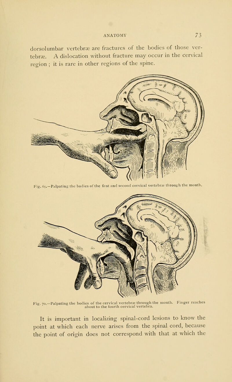 dorsolumbar vertebrae are fractures of the bodies of those ver- tebrae. A dislocation without fracture may occur in the cervical region ; it is rare in other regions of the spine. Pig- 69.—Palpating the bodies of the first and second cervical vertebrae through the mouth. Fig. 70.—Palpating the bodies of the cervical vertebrae through the mouth. Finger reaches about to the fourth cervical vertebra. It is important in localizing spinal-cord lesions to know the point at which each nerve arises from the spinal cord, because the point of origin does not correspond with that at which the