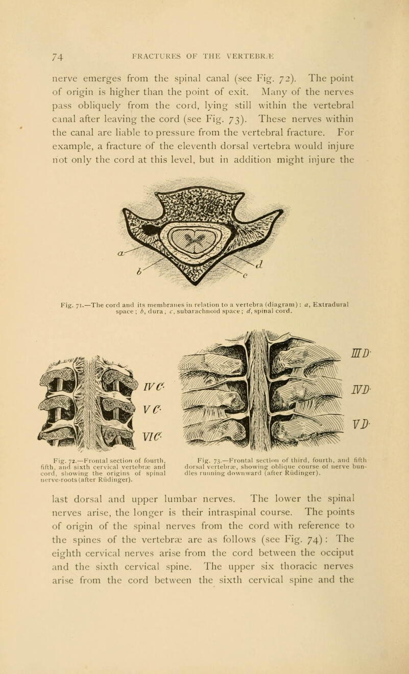 nerve emerges from the spinal canal (see Fig. 72). The point of origin is higher than the point of exit. Many of the nerves pass obliquely from the cord, King still within the vertebral canal after leaving the cord (see Fig. 73). These nerves within the canal are liable to pressure from the vertebral fracture. For example, a fracture of the eleventh dorsal vertebra would injure not only the cord at this level, but in addition might injure the Fig. 71.—The cord and its membranes in relation to a vertebra (diagram) : a, Extradural space; b, dura, c, subarachnoid space; rf, spinal cord. Fig. 72. —Frontal section of fourth, fifth, and sixth cervical vertebrae and Cord, showing the origins of spinal nerve-roots (after Riidinger). Fig. 73-—Frontal section of third, fourth, and fifth dorsal vertebrae, showing oblique course ol nerve bun dies running downward (after Riidinger). last dorsal and upper lumbar nerves. The lower the spinal nerves arise, the longer is their intraspinal course. The points of origin of the spinal nerves from the cord with reference to the spines of the vertebrae are as follows (see Fig. 74) : The eighth cervical nerves arise from the cord between the occiput and the sixth cervical spine. The upper six thoracic nerves arise from the cord between the sixth cervical spine and the