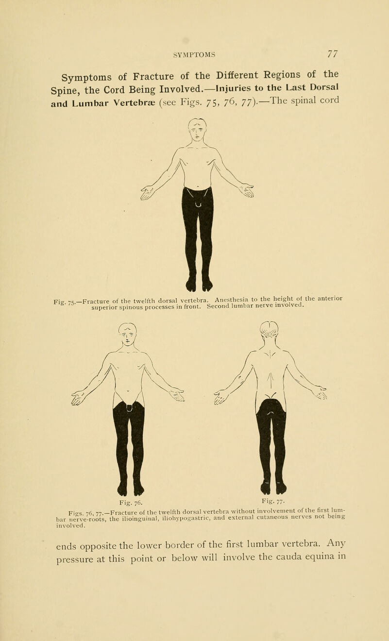 Symptoms of Fracture of the Different Regions of the Spine, the Cord Being Involved.—Injuries to the Last Dorsal and Lumbar Vertebrae (see Figs. 75, 76, 77).—The spinal cord Fig. 75—Fracture of the twelfth dorsal vertebra^ Anesthesia to the^height oi the anterior superior spinous processes in front. Second lumbar nerve involved. Fig. 76. FiS- 77- Fi°-s 76 77 —Fracture of the twelfth dorsal vertebra without involvement of the first lum- bar ne'rve-roots, the ilioinguinal, iliohypogastric, and external cutaneous nerves not being involved. ends opposite the lower border of the first lumbar vertebra. Any pressure at this point or below will involve the cauda equina in