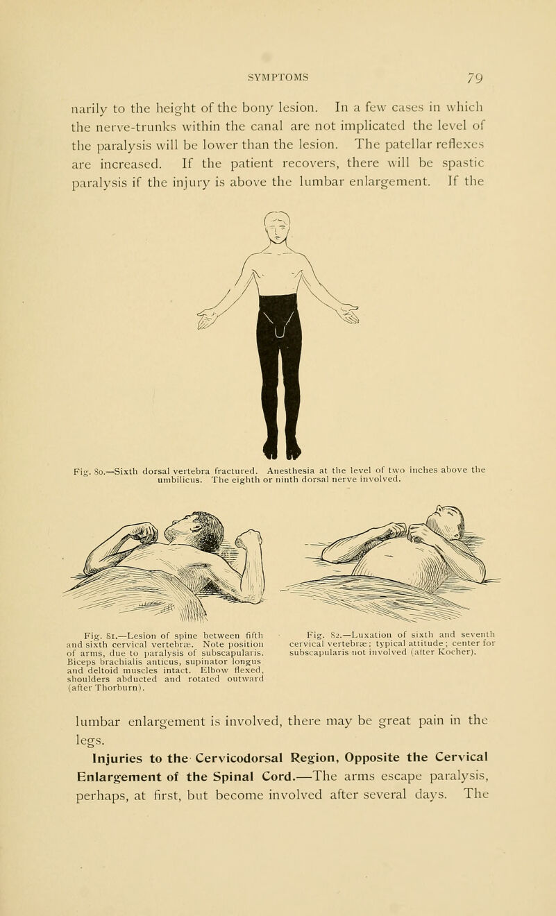 narily to the height of the bony lesion. In a (c\v cases in which the nerve-trunks within the canal are not implicated the level of the paralysis will be lower than the lesion. The patellar reflexes are increased. If the patient recovers, there will be spastic paralysis if the injury is above the lumbar enlargement. If the Fig. 80.—Sixth dorsal vertebra fractured. Anesthesia at the level of two inches above the umbilicus. The eighth or ninth dorsal nerve involved. Fig. 81.—Lesion of spine between fifth and sixth cervical vertebrae. Note position of arms, due to paralysis of subscapularis. Biceps brachialis amicus, supinator longus and deltoid muscles intact. Elbow flexed, shoulders abducted and rotated outward (after Thorburn). Fig. 82.—Luxation of sixth and seventh cervical vertebras ; typical attitude ; center for subscapularis not involved (alter Kocher). lumbar enlargement is involved, there may be great pain in the legs. Injuries to the Cervicodorsal Region, Opposite the Cervical Enlargement of the Spinal Cord.—The arms escape paralysis, perhaps, at first, but become involved after several days. The