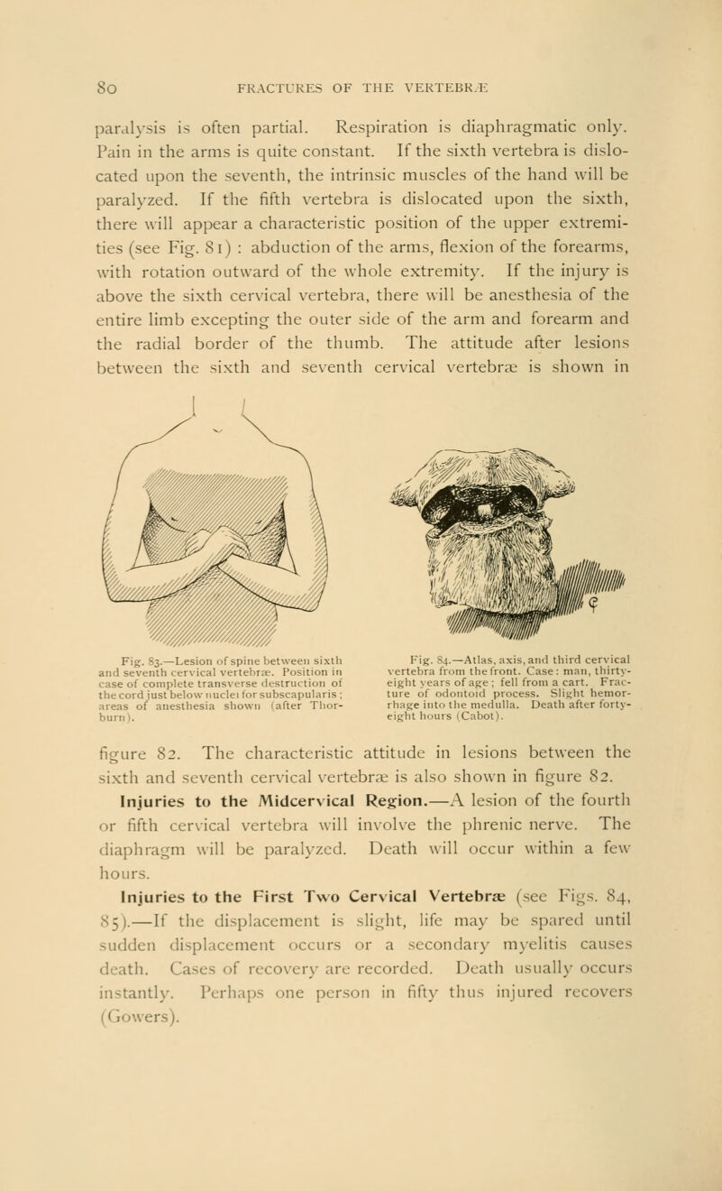 paralysis is often partial. Respiration is diaphragmatic only. Pain in the arms is quite constant. If the sixth vertebra is dislo- cated upon the seventh, the intrinsic muscles of the hand will be paralyzed. If the fifth vertebra is dislocated upon the sixth, there will appear a characteristic position of the upper extremi- ties (see Fig. Si) : abduction of the arms, flexion of the forearms, with rotation outward of the whole extremity. If the injury is above the sixth cervical vertebra, there will be anesthesia of the entire limb excepting the outer side of the arm and forearm and the radial border of the thumb. The attitude after lesions between the sixth and seventh cervical vertebras is shown in i y \ mm 4 m Fig. 83.—Lesion of spine between sixth and seventh cervical vertebrae. Position in case of complete transverse destruction of the cord just below nuclei for subscapularis ; areas of anesthesia shown (after Thor- burn). Fig. 84.—Atlas, axis, and third cervical vertebra from the front. Case: man, thirty- eight years of age ; fell from a cart. Frac- ture of odontoid process. Slight hemor- rhage into the medulla. Death after forty- eight hours (Cabot). figure 82. The characteristic attitude in lesions between the sixth and seventh cervical vertebrae is also shown in figure 82. Injuries to the Midcervical Region.—A lesion of the fourth or fifth cervical vertebra will involve the phrenic nerve. The diaphragm will be paralyzed. Death will occur within a few hours. Injuries to the First Two Cervical Vertebras (sec Figs. 84, 85).—If the displacement is slight, life may be spared until sudden displacement occurs or a secondary myelitis causes death. Cases of recover}- are recorded. Death usually occurs instantly. Perhaps one person in fifty thus injured recovers ers).