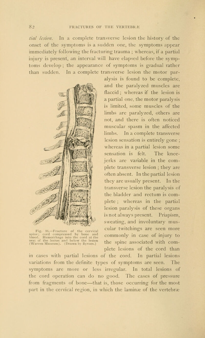tial lesion. In a complete transverse lesion the history of the onset of the symptoms is a sudden one, the symptoms appear immediately following the fracturing trauma ; whereas, if a partial injury is present, an interval will have elapsed before the symp- toms develop; the appearance of symptoms is gradual rather than sudden. In a complete transverse lesion the motor par- alysis is found to be complete, and the paralyzed muscles are flaccid ; whereas if the lesion is a partial one, the motor paralysis is limited, some muscles of the limbs are paralyzed, others are not, and there is often noticed muscular spasm in the affected limbs. In a complete transverse lesion sensation is entirely gone ; whereas in a partial lesion some sensation is felt. The knee- jerks are variable in the com- plete transverse lesion ; they are often absent. In the partial lesion they are usually present. In the transverse lesion the paralysis oi the bladder and rectum is com- plete ; whereas in the partial lesion paralysis of these organs is not always present. Priapism, sweating, and involuntary mus- cular twitchings are seen more spine; cord compressed by bone and rommonlv in rase of iniurv to blood. Hemorrhage into the cord al the commonly m case 01 injur) CO ,1' lesio •l below the lesion .1 crvin#» iccnriar^H u/irli rnm (Warren Museum). (Drawn by Byrnes.) me spine associated WUIl com- plete lesions of the cord than in cases with partial lesions of the cord. In partial lesions variations from the definite types of symptoms are seen. The symptoms are more or less irregular. In total lesions of the cord operation can do no good. The cases of pressure from fragments of bone—that is, those occurring for the most part in the cervical region, in which the laminae of tin vertebrae 56. — Fracture of the cervical