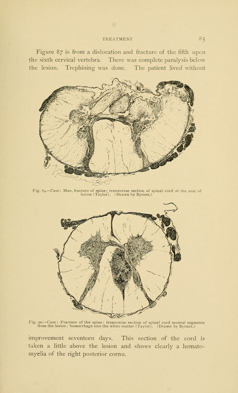 Figure Sy is from a dislocation and fracture of the fifth upon the sixth cervical vertebra. There was complete paralysis below the lesion. Trephining was done. The patient lived without Fig. Sg.—Case: Man, fracture of spine; transverse section of spinal cord at the seat of lesion (Taylor). (Drawn by Byrnes.) Fig. 90.—Case: Fracture of the spine; transverse section of spinal cord several segments from the lesion ; hemorrhage into the white matter (Taylor). (Drawn by Byrnes.) improvement seventeen days. This section of the cord is taken a little above the lesion and shows clearly a hemato- myelia of the right posterior cornu.