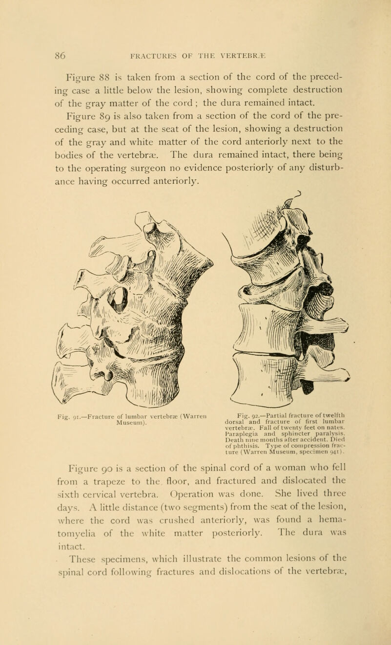 Figure 88 is taken from a section of the cord of the preced- ing case a little below the lesion, showing complete destruction of the gray matter of the cord ; the dura remained intact. Figure 89 is also taken from a section of the cord of the pre- ceding case, but at the seat of the lesion, showing a destruction of the gray and white matter of the cord anteriorly next to the bodies of the vertebrae. The dura remained intact, there being to the operating surgeon no evidence posteriorly of any disturb- ance having occurred anteriorly. Fig. 91.—Fracture of lumbar vertebrae (Warren Fig. 92.—Partial fracture of twelfth Museum). dorsal and fracture of first lumbal vertebrae. Fall of twenty feet on nates. Paraplegia and sphincter paralysis. Death nine months after accident. Died of phthisis. Type of compression frac- ture (Warren Museum, specimen 941). Figure 90 is a section of the spinal cord of a woman who fell from a trapeze to the floor, and fractured and dislocated the sixth cervical vertebra. < )peration was done. She lived three days. A little distance (two segments) from the seat of the lesion, where the cord was crushed anteriorly, was found a hema- tomyelia of the white matter posteriorly. The dura was intact. These specimens, which illustrate the common lesions of the spinal cord following fractures and dislocations of the vertebrae,