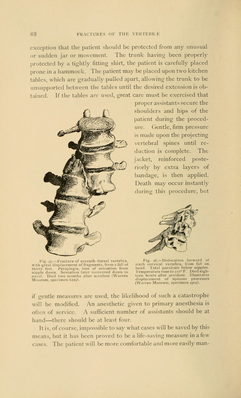 exception that the patient should be protected from any unusual or sudden jar or movement. The trunk having been properly protected by a tightly fitting shirt, the patient is carefully placed prone in a hammock. The patient may be placed upon two kitchen tables, which are gradually pulled apart, allowing the trunk to be unsupported between the tables until the desired extension is ob- tained. If the tables are used, great care must be exercised that proper assistants secure the shoulders and hips of the patient during the proced- ure. Gentle, firm pressure is made upon the projecting ^yP^h vertebral spines until re- duction is complete. The jacket, reinforced poste- riorly by extra layers of bandage, is then applied. Death may occur instantly during this procedure, but Fig. 95-—Fracture of seventh dorsal vertebra, with great displacement of fragments, from a fall oi thirty feet. Paraplegia, loss of sensation from nipple down. Sensation later recovered down to navel. Died two months after accident (Warren Museum, specimen 6229). Fig. 96.—Dislocation forward ol sixth cervical vertebra, from fall on head. Total paralysis below nipples. Temperature rose to 110° F. Died eigh- teen hours after accident. Illustrates displacement of spinous processes (Warren Museum, specimen 4904). if gentle measures are used, the likelihood of such a catastrophe will be modified. An anesthetic given to primary anesthesia is often of service. A sufficient number of assistants should be at hand—there should be at least four. It is, of course, impossible to say what cases will be saved by this means, but it has been proved to be a life-saving measure in a few . The patient will be more comfortable and more easily man-