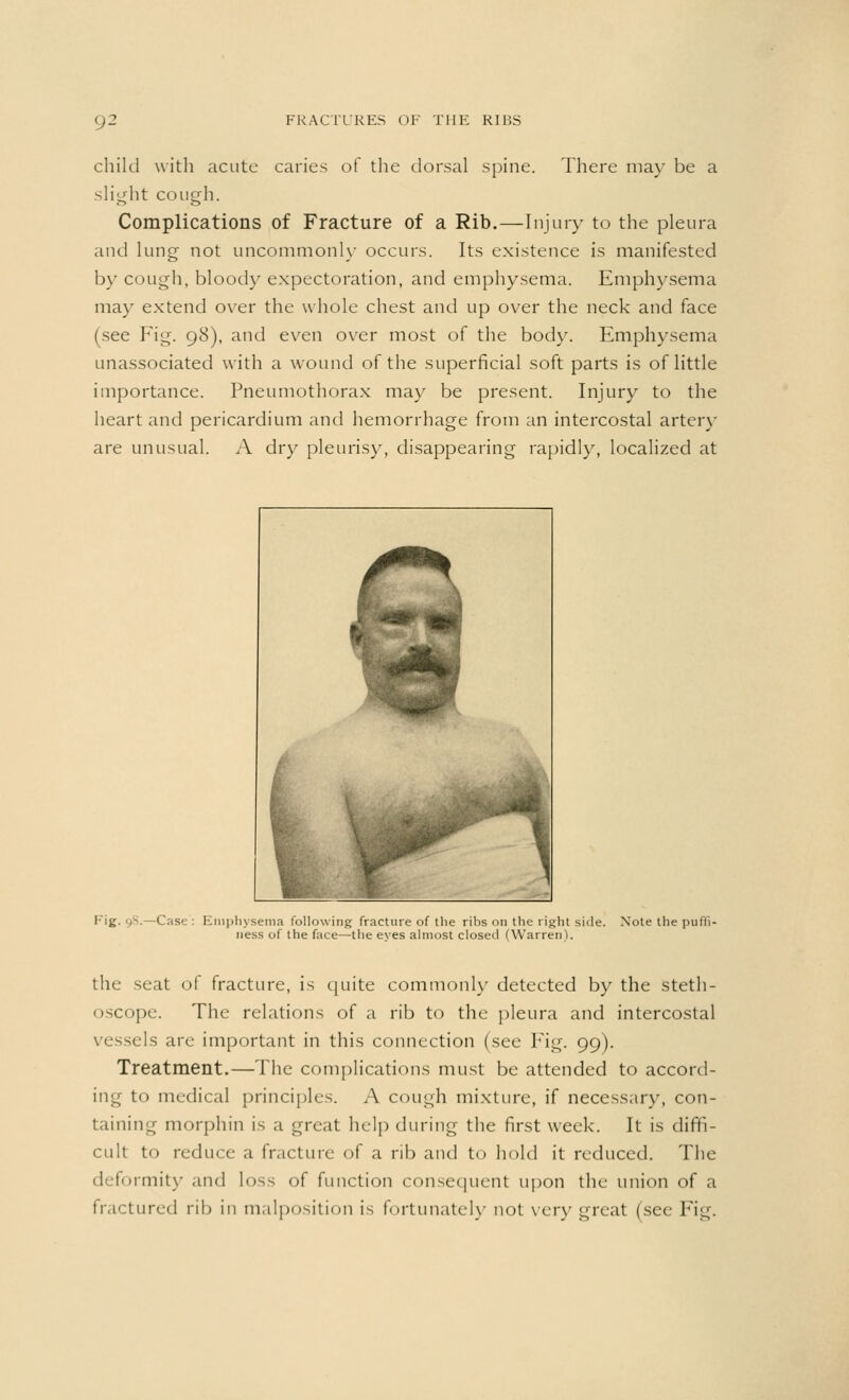 child with acute caries of the dorsal spine. There may be a slight cough. Complications of Fracture of a Rib.—Injury to the pleura and lung not uncommonly occurs. Its existence is manifested by cough, blood\r expectoration, and emphysema. Emphysema may extend over the whole chest and up over the neck and face (see Fig. 98), and even over most of the body. Emphysema unassociated with a wound of the superficial soft parts is of little importance. Pneumothorax may be present. Injury to the heart and pericardium and hemorrhage from an intercostal artery are unusual. A dry pleurisy, disappearing rapidly, localized at Fig. 98.—Case: Emphysema following fracture of the ribs on the right side. Note the puffi ness of the face—the eyes almost closed (Warren). the seat of fracture, is quite commonly detected by the steth- oscope. The relations of a rib to the pleura and intercostal vessels are important in this connection (see Fig. 99). Treatment.—The complications must be attended to accord- ing to medical principles. A cough mixture, if necessary, con- taining morphin is a great help during the first week. It is diffi- cult to reduce a fracture of a rib and to hold it reduced. The deformity and loss of function consequent upon the union of a fractured rib in malposition is fortunately not very great (see Fig.