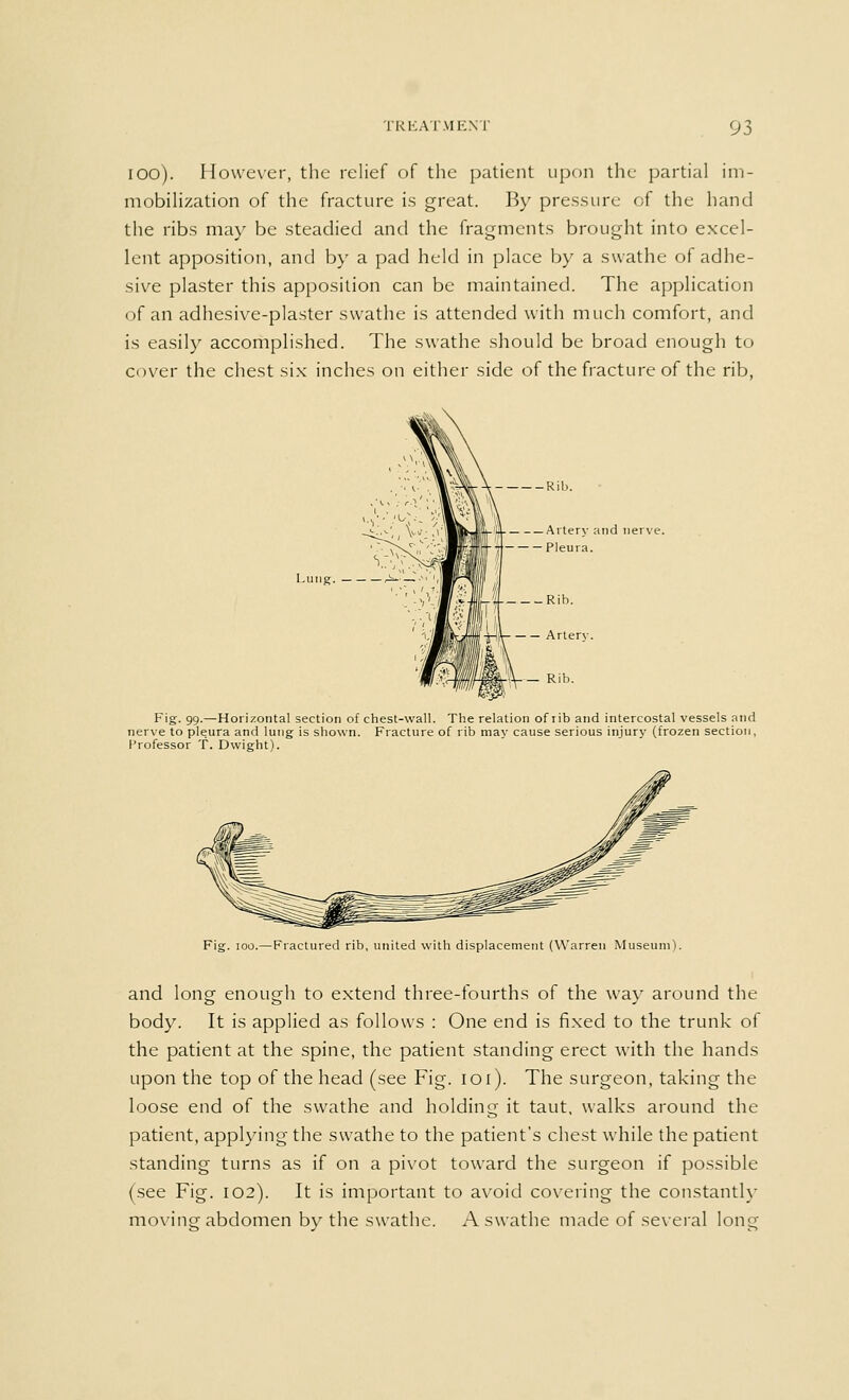 100). However, the relief of the patient upon the partial im- mobilization of the fracture is great. By pressure of the hand the ribs may be steadied and the fragments brought into excel- lent apposition, and by a pad held in place by a swathe of adhe- sive plaster this apposition can be maintained. The application of an adhesive-plaster swathe is attended with much comfort, and is easily accomplished. The swathe should be broad enough to cover the chest six inches on either side of the fracture of the rib, Lung. Rib. ■ Artery and nerve. Pleura. .Rib. Artery. — Rib. Fig. 99.—Horizontal section of chest-wall. The relation of rib and intercostal vessels and nerve to pleura and lung is shown. Fracture of rib may cause serious injury (frozen section, Professor T. Dwight). Fig. ioo.—Fractured rib, united with displacement (Warren Museum). and long enough to extend three-fourths of the way around the body. It is applied as follows : One end is fixed to the trunk of the patient at the spine, the patient standing erect with the hands upon the top of the head (see Fig. ioi). The surgeon, taking the loose end of the swathe and holding it taut, walks around the patient, applying the swathe to the patient's chest while the patient standing turns as if on a pivot toward the surgeon if possible (see Fig. 102). It is important to avoid covering the constantly moving abdomen bv the swathe. A swathe made of several long