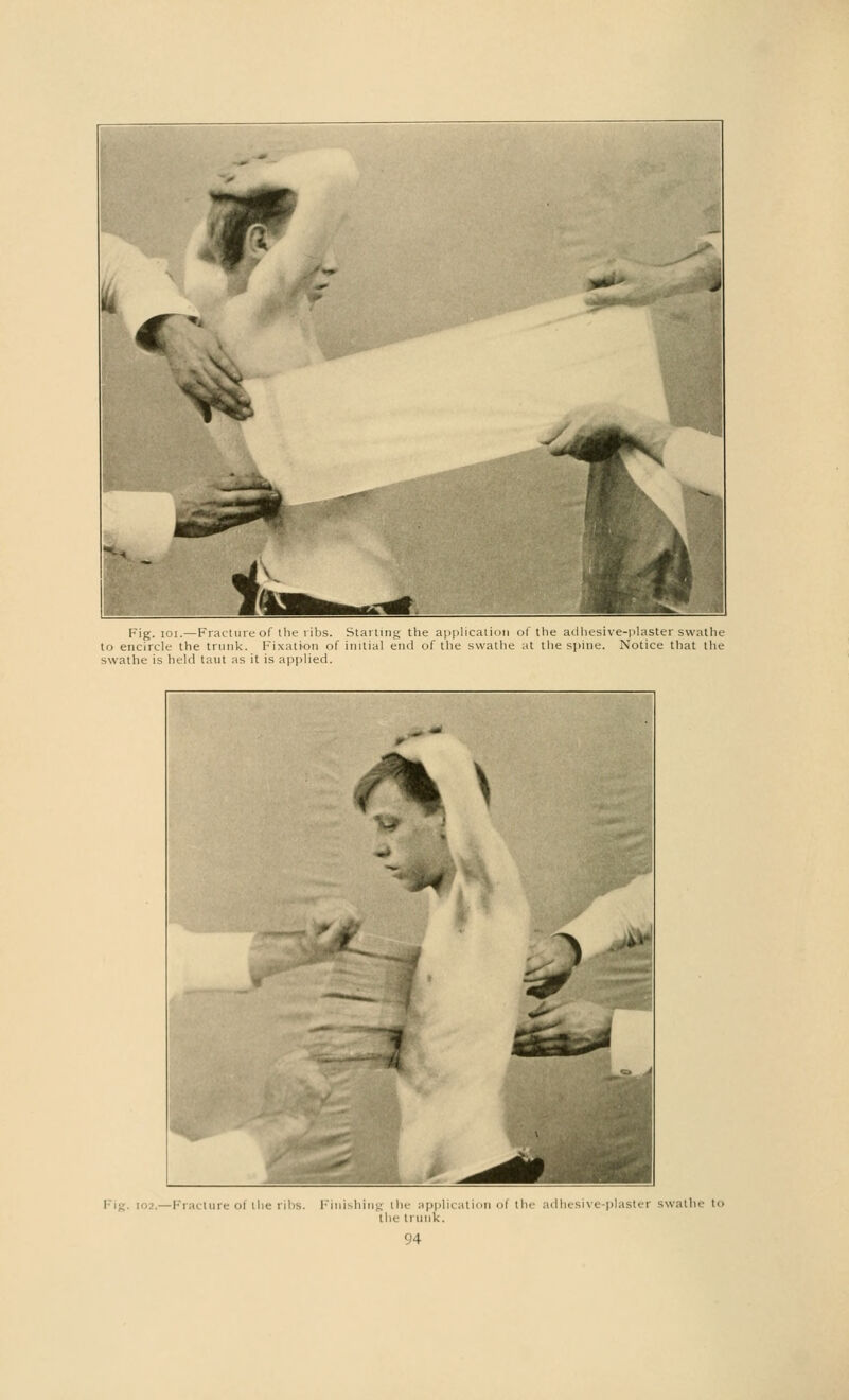 Fig. 101.—Fracture of the ribs. Starting the application of the adhesive-plaster swathe to encircle the trunk. Fixation of initial end of the swathe at the spine. Notice that the swathe is held taut as it is applied. Fracture of the ribs. Finishing tin application ol the adhesive-plaster swathe to the trunk.