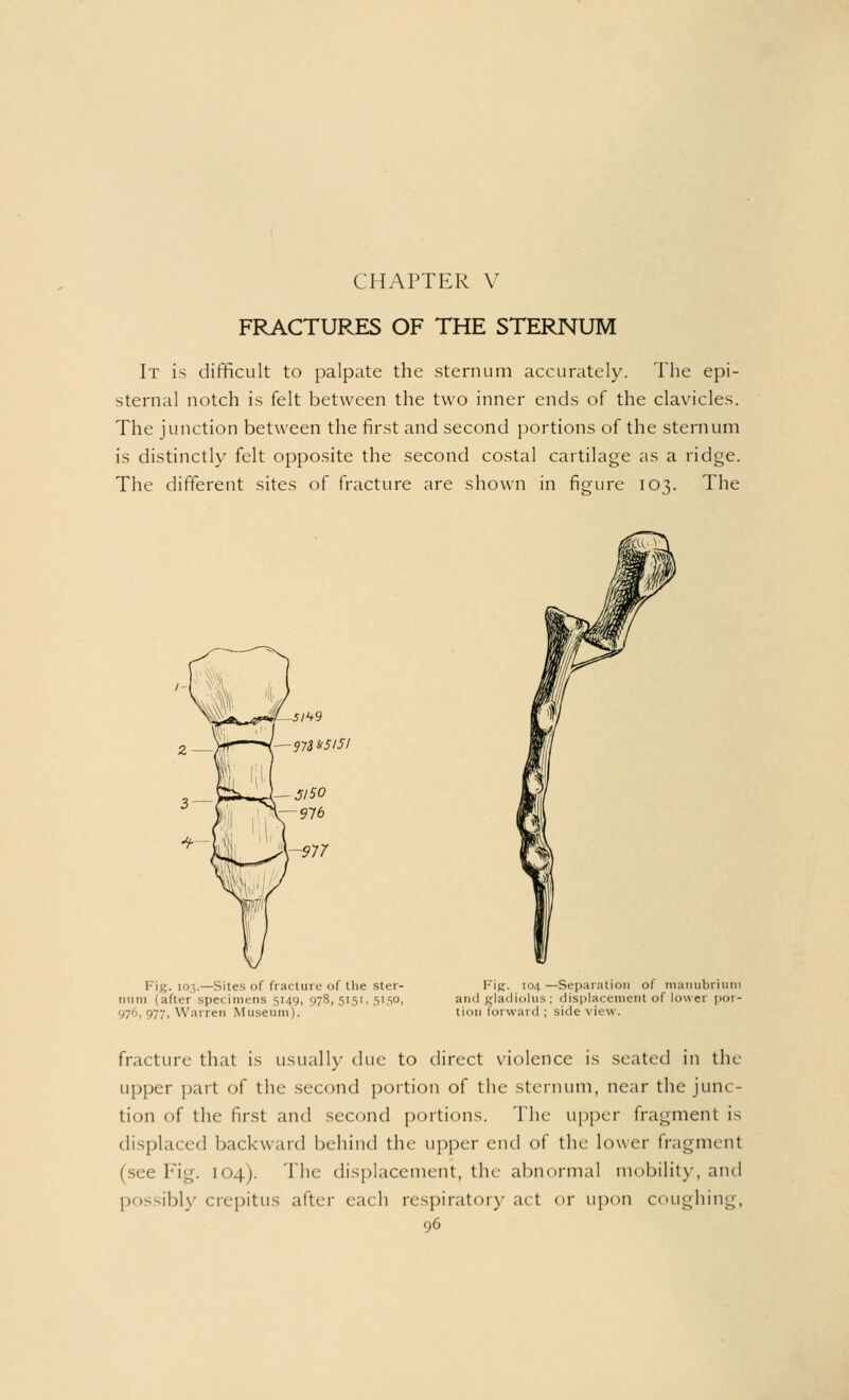 FRACTURES OF THE STERNUM It is difficult to palpate the sternum accurately. The epi- sternal notch is felt between the two inner ends of the clavicles. The junction between the first and second portions of the sternum is distinctly felt opposite the second costal cartilage as a ridge. The different sites of fracture are shown in figure 103. The Fig. 103.—Sites of fracture of the ster- num (after specimens 5149, 978,5151,5150, 976, 977, Warren Museum). Fig. 104 —Separation of manubrium and gladiolus ; displacement of lower por- tion forward ; side view. fracture that is usually due to direct violence is seated in the upper part of the second portion of the sternum, near the junc- tion of the first and second portions. The upper fragment is displaced backward behind the upper end of the lower fragment (see Fig. 104). The displacement, the abnormal mobility, and possibly crepitus after each respiratory act or upon coughing,