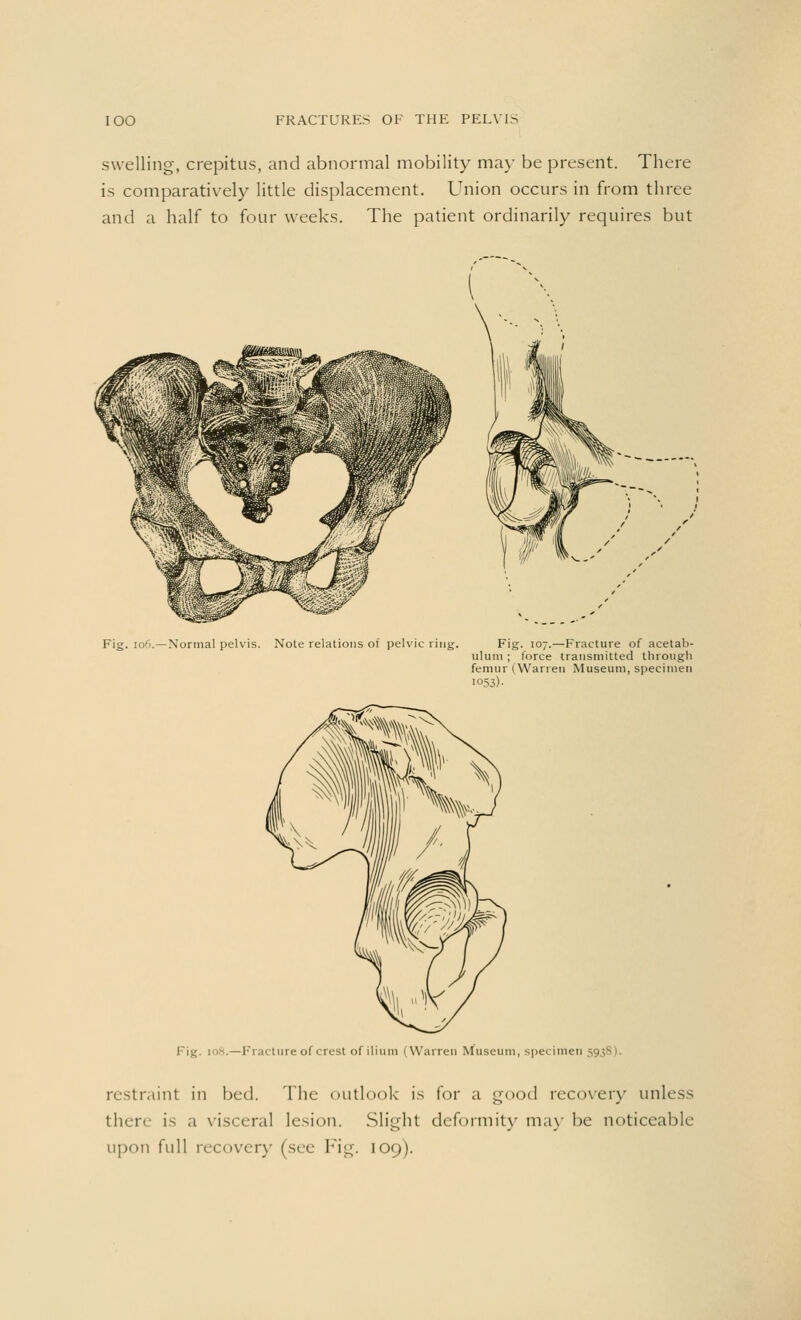 swelling, crepitus, and abnormal mobility may be present. There is comparatively little displacement. Union occurs in from three and a half to four weeks. The patient ordinarily requires but Fig. 106.—Normal pelvis. Note relations of pelvic ring. Fig. 107.—Fracture of acetab- ulum ; force transmitted through femur (Warren Museum, specimen i°53)- —Fracture of crest of ilium (Warren Museum, specimen 59.isi. restraint in bed. The outlook is for a good recover}' unless then- is a visceral lesion. Slight deformity may be noticeable upon full recovery (see Fig. 109).