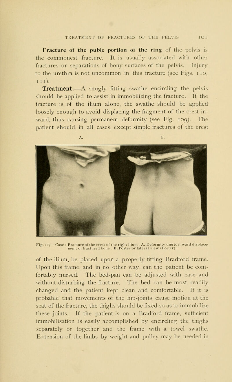 Fracture of the pubic portion of the ring of the pelvis is the commonest fracture. It is usually associated with other fractures or separations of bony surfaces of the pelvis. Injury to the urethra is not uncommon in this fracture (see Figs. I 10, in). Treatment.—A snugly fitting swathe encircling the pelvis should be applied to assist in immobilizing the fracture. If the fracture is of the ilium alone, the swathe should be applied loosely enough to avoid displacing the fragment of the crest in- ward, thus causing permanent deformity (see Fig. log). The patient should, in all cases, except simple fractures of the crest Fig. 109.—Case : Fracture of the crest of the right ilium : A, Deformity due to inward displace- ment of fractured bone; E, Posterior lateral view (Porter). of the ilium, be placed upon a properly fitting Bradford frame. Upon this frame, and in no other way, can the patient be com- fortably nursed. The bed-pan can be adjusted with ease and without disturbing the fracture. The bed can be most readily changed and the patient kept clean and comfortable. If it is probable that movements of the hip-joints cause motion at the seat of the fracture, the thighs should be fixed so as to immobilize these joints. If the patient is on a Bradford frame, sufficient immobilization is easily accomplished by encircling the thighs separately or together and the frame with a towel swathe. Extension of the limbs by weight and pulley may be needed in