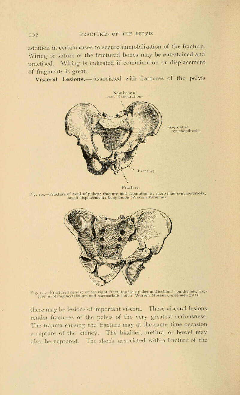 addition in certain cases to secure immobilization of the fracture. Wiring or suture of the fractured bones may be entertained and practised. Wiring is indicated if comminution or displacement of fragments is great. Visceral Lesions.—Associated with fractures of the pelvis New bone at seat of separation. • Sacro-iliac synchondrosis. pig, no.—Fracture of rami of pubes; fracture and separation at sacro-iliac synchondrosis; much displacement; bony union (Warren Museum). l--j<r. ,,, Fractured pelvis: on the right, fracture across pubes and ischium ; on the left, frac- ture involving acetabulum and sacrosciatic notch (Warren Museum, specimen 3857). there may be lesions of important viscera. These visceral lesions render fractures of the pelvis of the very greatest seriousness. The trauma causing the fracture may at the same time occasion a rupture of the kidney. The bladder, urethra, or bowel may ;i1m. be ruptured. The shock associated with a fracture of the