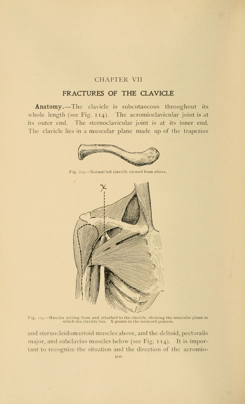 CHAPTER VII FRACTURES OF THE CLAVICLE Anatomy.—The clavicle is subcutaneous throughout its whole length (see Fig. 114). The acromioclavicular joint is at its outer end. The sternoclavicular joint is at its inner end. The clavicle lies in a muscular plane made up of the trapezius Fig. 113.—Normal left clavicle viewed from above. Fig, 111. Muscles arising from and attached to the clavicle, showing the muscular plane in which the • l.u icle lies. X points to the coracoid process. and sternocleidomastoid muscles abi >ve, and the deltoid, pect oralis major, and subclavius muscles below (see Fig. 1 14). It is impor- tant to n-i ognize the situation and the direction of the acromio- IO()