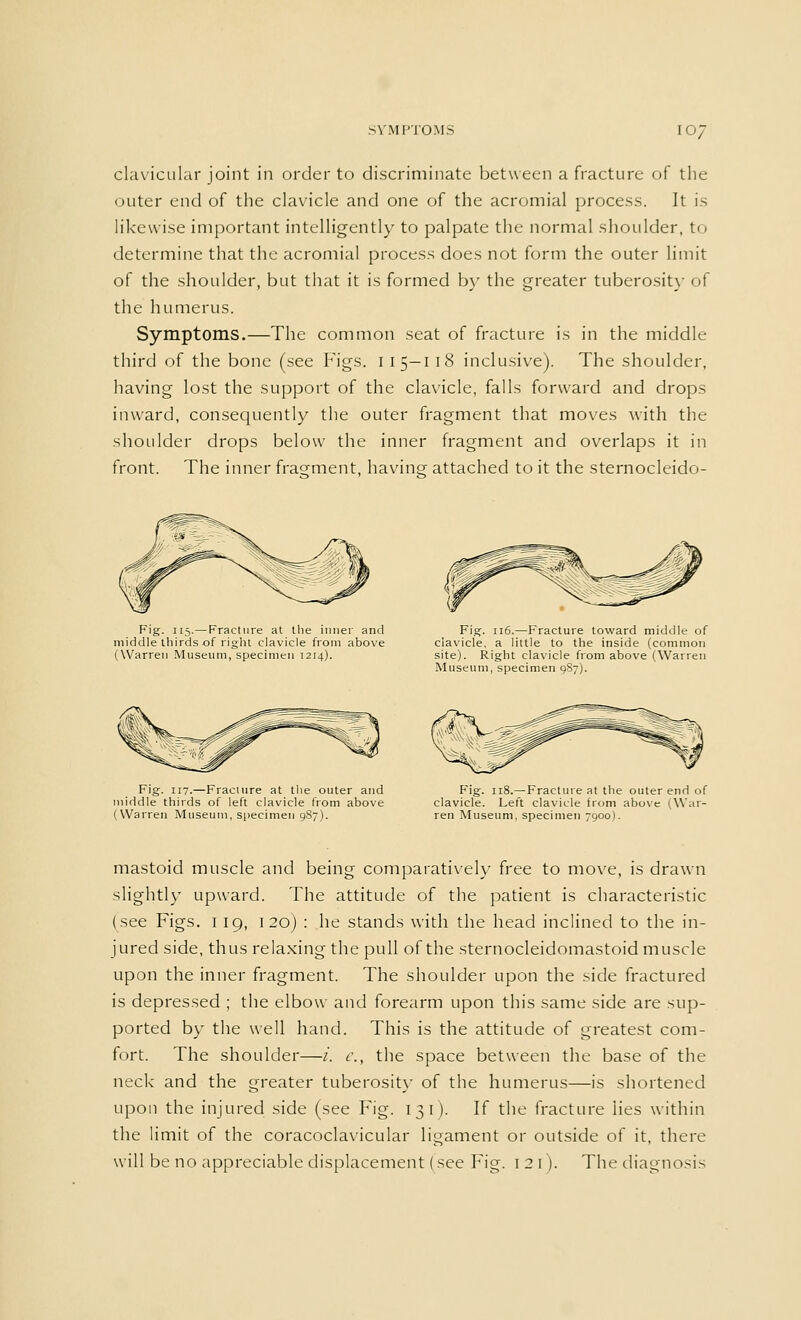 clavicular joint in order to discriminate between a fracture of the outer end of the clavicle and one of the acromial process. It is likewise important intelligently to palpate the normal shoulder, to determine that the acromial process does not form the outer limit of the shoulder, but that it is formed by the greater tuberosity of the humerus. Symptoms.—The common seat of fracture is in the middle third of the bone (see Figs. 115-118 inclusive). The shoulder, having lost the support of the clavicle, falls forward and drops inward, consequently the outer fragment that moves with the shoulder drops below the inner fragment and overlaps it in front. The inner fragment, having attached to it the sternocleido- Fig. 115.— Fracture at the inner and middle thirds .of right clavicle from above (Warren Museum, specimen 1214). Fig. 116.—Fracture toward middle of ciavicle, a little to the inside (common site). Right clavicle from above (Warren Museum, specimen 987). Fig. 117.—Fracture at the outer and middle thirds of left clavicle from above (Warren Museum, specimen 987). Fig. 118.—Fracture at the outer end of clavicle. Left clavicle from above (War- ren Museum, specimen 7900). mastoid muscle and being comparatively free to move, is drawn slightly upward. The attitude of the patient is characteristic (see Figs, i 19, 1 20) : he stands with the head inclined to the in- jured side, thus relaxing the pull of the sternocleidomastoid muscle upon the inner fragment. The shoulder upon the side fractured is depressed ; the elbow and forearm upon this same side are sup- ported by the well hand. This is the attitude of greatest com- fort. The shoulder—/'. e., the space between the base of the neck and the greater tuberosity of the humerus—is shortened upon the injured side (see Fig. 131). If the fracture lies within the limit of the coracoclavicular ligament or outside of it, there will be no appreciable displacement (see Fig. 121). The diagnosis