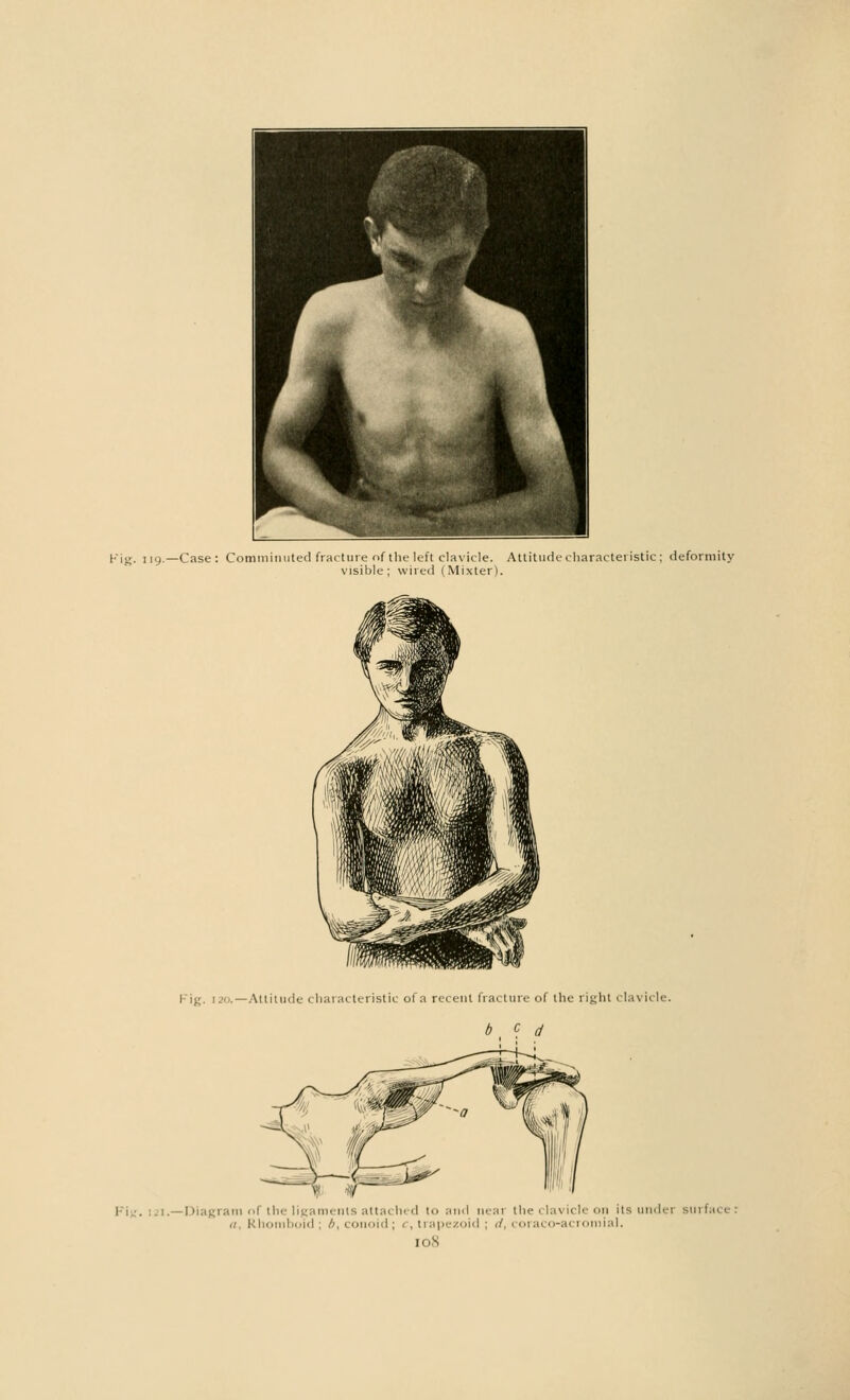 Kij;. 119.—Case: Comminuted fracture of the left clavicle. Attitude characteristic ; deformity visible; wired (Mixter). ..—Attitude characteristic of a recent fracture of the right clavicle. b C d i, :. Diagram of the ligaments attached to and neai the clavicle on its undei surface: a. Rhomboid ; b, conoid; c, trapezoid j d, coraco-a al. 10S