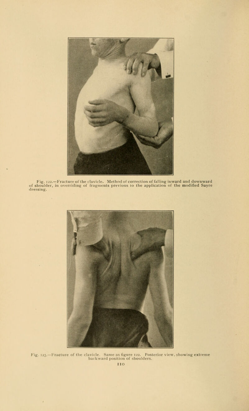 Fig. 122.—Fracture ol the clavicle. Method of correction of falling inward and downward of shoulder, in overriding of fragments previous to the application of the modified Sayre dressing. Fig. i.'.-,. Fracture of the clavicle. Same as figure 122. Posterior view, showing extreme backward position ol shoulders.