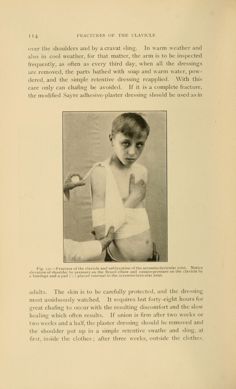 H4 over the shoulders and by a cravat sling. In warm weather and also in cool weather, for that matter, the arm is to be inspected frequently, as often as every third day, when all the dressings are removed, the parts bathed with soap and warm water, pow- dered, and the simple retentive dressing reapplied. With this care only can chafing be avoided. If it is a complete fracture, the modified Sayre adhesive-plaster dressing should be used as in PiK. 130.—Fracture of the clavicle and subluxation of the acromioclavicular joint. Notice elevation of shoulder by pressure on the Hexed elbow and counterpressure on the clavicle by a bandage and a pad 1 1 placed internal to the acromioclavicular joint. adults. The skin is to be carefully protected, and the dressing most assiduously watched. It requires but forty-eight hours for great chafing to occur with the resulting discomfort and the slow healing which often results. If union is firm after two weeks or two weeks and a half, the plaster dressing should be removed and the shoulder put up in a simple retentive swathe and sling, at first, inside the clothes; after three weeks, outside the clothes.