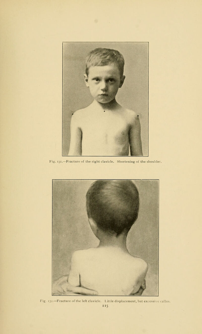 Fig. 131.—Fracture of the right clavicle. Shortening of the shoulder. Fig. 132.—Fracture of the left clavicle. Little displacement, but excessh e (.alius