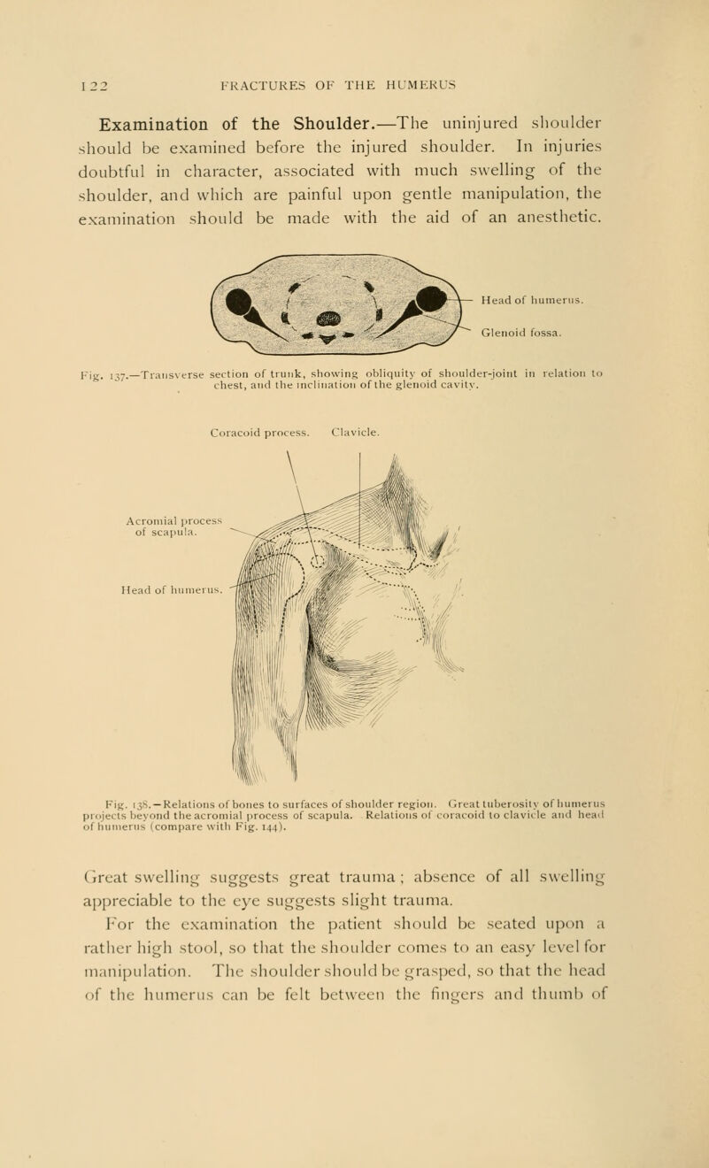 Examination of the Shoulder.—The uninjured shoulder should be examined before the injured shoulder. In injuries doubtful in character, associated with much swelling of the shoulder, and which are painful upon gentle manipulation, the examination should be made with the aid of an anesthetic. Head of humerus. Glenoid fossa. Fig. H7-—Transverse section of trunk, showing obliquity of shoulder-joint in relation tt chest, and the inclination of the glenoid cavity. Coracoid process. Clavicle. Acromial process of scapula. Head of humerus. Fig. i;,s. —Relations of bones to surfaces of shoulder region. Great tuberosity of humerus s beyond the acromial process of scapula. Relations of coracoid to clavicle and head of humerus (compare with Fig. 144). < rreat swelling suggests great trauma ; absence of all swelling appreciable to the eye suggests slight trauma. For the examination the patient should be sealed upon a rather high stool, so that the shoulder comes to an easy level for manipulation. The shoulder should be grasped, so that the head of the humerus can be felt between the fingers and thumb of