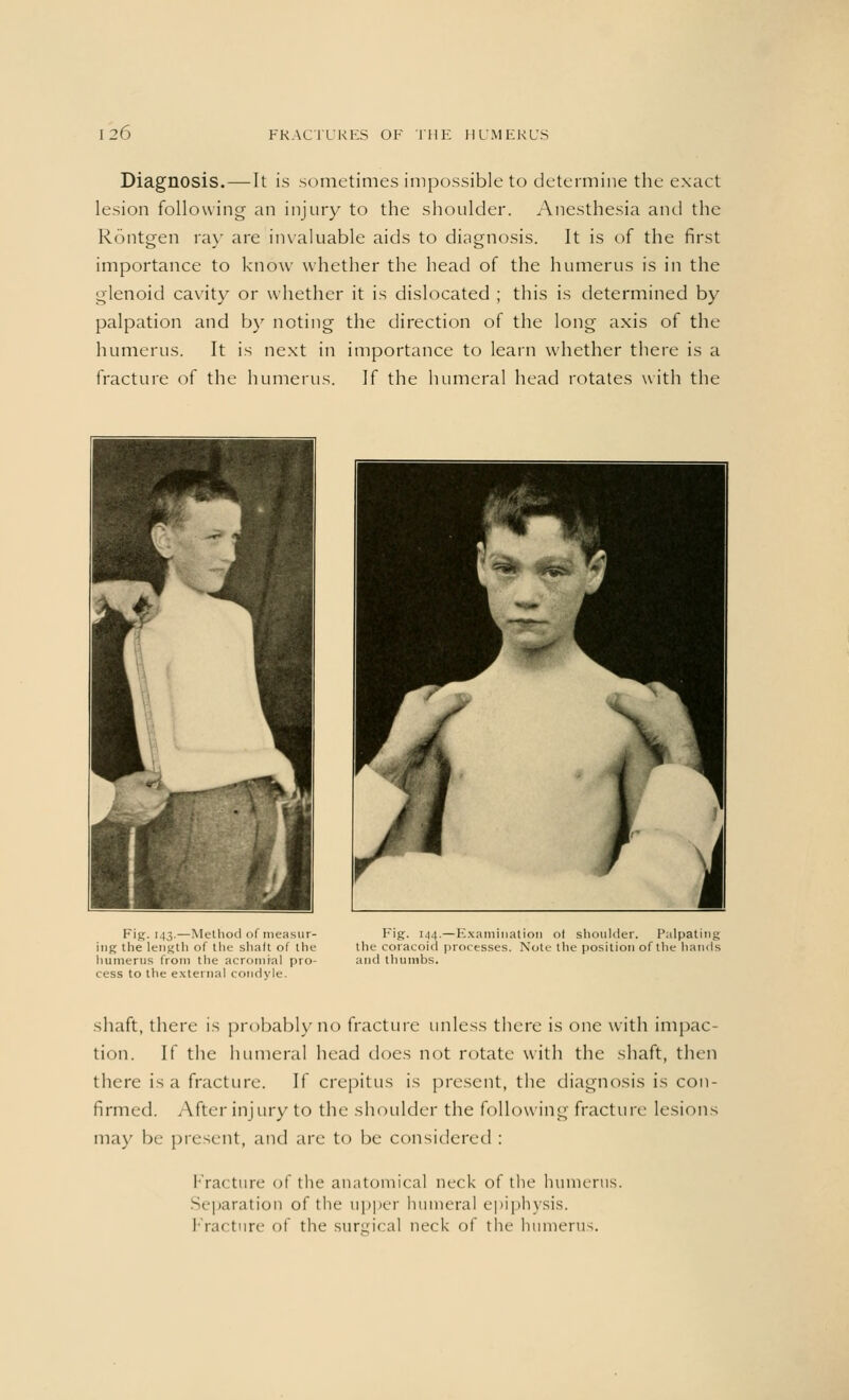 Diagnosis.—It is sometimes impossible to determine the exact lesion following an injury to the shoulder. Anesthesia and the Rontgen ray are invaluable aids to diagnosis. It is of the first importance to know whether the head of the humerus is in the glenoid cavity or whether it is dislocated ; this is determined by palpation and by noting the direction of the long axis of the humerus. It is next in importance to learn whether there is a fracture of the humerus. If the humeral head rotates with the Fig. 143.—Method of measur- ing the length of the shaft of the humerus from the acromial pro- cess to the external condyle. Fig. 144.—Examination of shoulder. Palpating the coracoid processes. Note the position of the hands and thumbs. shaft, there is probably no fracture unless there is one with impac- tion. If the humeral head does not rotate with the shaft, then there is a fracture. If crepitus is present, the diagnosis is con- firmed. After injury to the shoulder the following fracture lesions may be present, and are to be considered : fracture of the anatomical neck of the humerus. Separation of the upper humeral epiphysis. I racture of the surgical neck of the humerus.