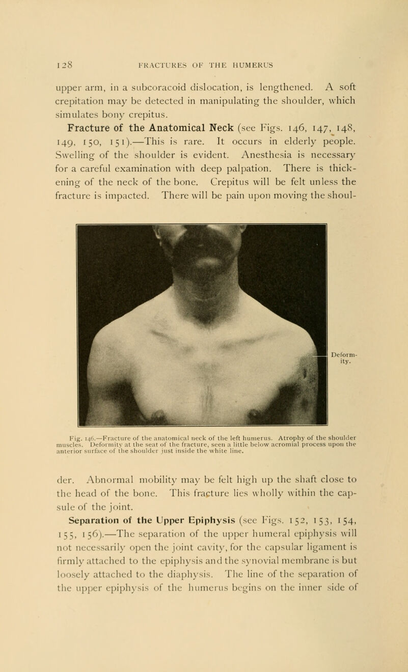 upper arm, in a subcoracoid dislocation, is lengthened. A soft crepitation may be detected in manipulating the shoulder, which simulates bony crepitus. Fracture of the Anatomical Neck (see Figs. 146, 147, 148, 149, 150, 151).—This is rare. It occurs in elderly people. Swelling of the shoulder is evident. Anesthesia is necessary for a careful examination with deep palpation. There is thick- ening of the neck of the bone. Crepitus will be felt unless the fracture is impacted. There will be pain upon moving the shoul- Fig. 146.—Fracture of the anatomical neck of the left humerus. Atrophy of the shoulder muscles. Deformity at the seat of the fracture, seen a little below acromial process upon the anterior surface of the shoulder just inside the white line. der. Abnormal mobility may be felt high up the shaft close to the head of the bone. This fracture lies wholly within the cap- sule of the joint. Separation of the Upper Epiphysis (see Figs. 152, 153, 154, 155, 156).—The separation of the upper humeral epiphysis will not necessarily open the joint cavity, for the capsular ligament is firmly attached to the epiphysis and the synovial membrane is but loosely attached to the diaphysis. The line of the separation of the upper epiphysis <>f the humerus begins on the inner side of