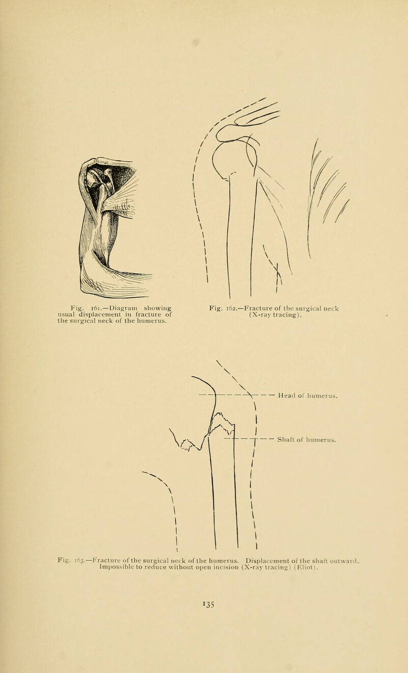 Fig. 161.—Diagram showing usual displacement in fracture of the surgical neck of the humerus. Fig. 162.—Fracture of the surgical neck (X-ray tracing). — Head of humerus. Shaft of humerus Fig. 163.—Fracture of the surgical neck of the humerus. Displacement of the shall outwan Impossible to reduce without open incision (X-ray tracing 1 (Eliot).