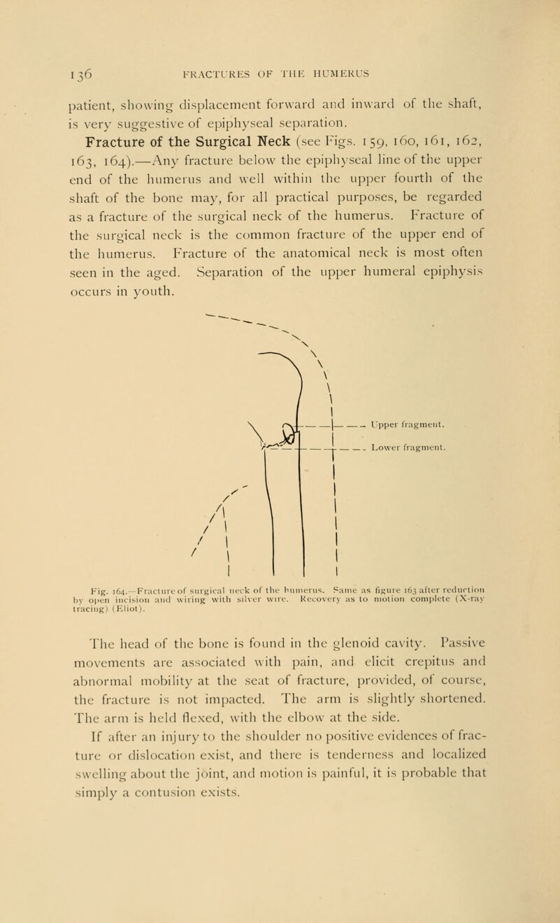 patient, showing displacement forward and inward of the shaft, is very suggestive of epiphyseal separation. Fracture of the Surgical Neck (see Figs. 159, 160, 161, 162, 163, 164).—Any fracture below the epiphyseal line of the upper end of the humerus and well within the upper fourth of the shaft of the bone may, for all practical purposes, be regarded as a fracture of the surgical neck of the humerus. Fracture of the surgical neck is the common fracture of the upper end of the humerus. Fracture of the anatomical neck is most often seen in the aged. Separation of the upper humeral epiphysis occurs in youth. . — Upper fragment. __ Lower fragment. Fig. 164.—Fracture of surgical neck of the humerus. Same as Bgure 163 after reduction by open incision and wiring with silver win-. Recovery as to motion complete (X-ray tracing) (Eliot). The head of the bone is found in the glenoid cavity. Passive movements are associated with pain, and elicit crepitus and abnormal mobility at the seat of fracture, provided, of course, the fracture is not impacted. The arm is slightly shortened. The arm is held flexed, with the elbow at the side. If after an injur)-to the shoulder no positive evidences of frac- ture or dislocation exist, and there is tenderness and localized swelling about the joint, and motion is painful, it is probable that simply a contusion exists.