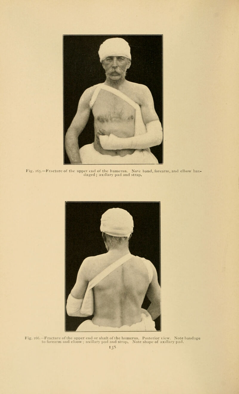 Fiu- 165.—Fracture of the upper end of the humerus. No'e hand, forearm, ami elbow ban da.^ed ; axillary pad and strap. Fractun of the upper end or shaft of ihe humerus. Posterior view. Note bandage to forearm and elbow ; axillary pad and strap. Note shape of axillary pad.