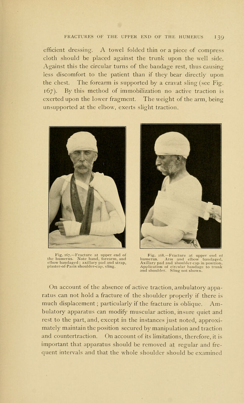 efficient dressing. A towel folded thin or a piece of compress cloth should be placed against the trunk upon the well side. Against this the circular turns of the bandage rest, thus causing less discomfort to the patient than if they bear directly upon the chest. The forearm is supported by a cravat sling (see Fig. 167). By this method of immobilization no active traction is exerted upon the lower fragment. The weight of the arm, being unsupported at the elbow, exerts slight traction. Fig. 167.—Fracture at upper end of the humerus. Note hand, forearm, and elbow bandaged ; axillary pad and strap, plaster-of-Paris shoulder-cap, sling. Fig. 168.—Fracture at upper end of humerus. Arm and elbow bandaged. Axillary pad and shoulder-cap in position. Application of circular bandage to trunk and shoulder. Sling not shown. On account of the absence of active traction, ambulatory appa- ratus can not hold a fracture of the shoulder properly if there is much displacement; particularly if the fracture is oblique. Am- bulatory apparatus can modify muscular action, insure quiet and rest to the part, and, except in the instances just noted, approxi- mately maintain the position secured by manipulation and traction and countertraction. On account of its limitations, therefore, it is important that apparatus should be removed at regular and fre- quent intervals and that the whole shoulder should be examined
