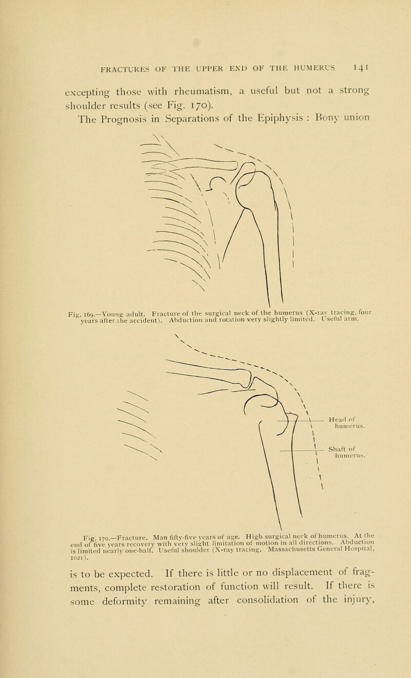 excepting those with rheumatism, a useful but not a strong shoulder results (see Fig. 170). The Prognosis in Separations of the Epiphysis : Bony union Fi. 169.—Young adult. Fracture of the surgical neck of the humerus (X-ray tracing, four ° years after ihe accident). Abduction and rotation very slightly limited. Useful arm. Head of \ humerus. Shaft of humerus Fig 170.—Fracture. Man fifty-five years of age. High surgical neck of humerus. At the end of five years recovery with very slight limitation of motion in all directions. Abduction is limited nearly one-half. Useful shoulder (X-ray tracing. Massachusetts General Hospital, 1021). is to be expected. If there is little or no displacement of frag- ments, complete restoration of function will result. If there is some deformity remaining after consolidation of the injury,