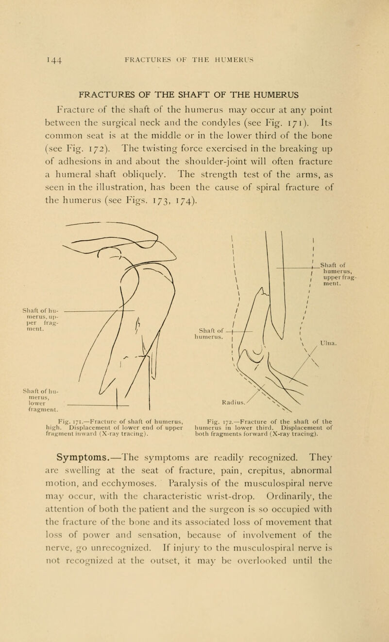 FRACTURES OF THE SHAFT OF THE HUMERUS Fracture of the shaft of the humerus may occur at any point between the surgical neck and the condyles (see Fig. 171). Its common seat is at the middle or in the lower third of the bone (see Fig. 172). The twisting force exercised in the breaking up of adhesions in and about the shoulder-joint will often fracture a humeral shaft obliquely. The strength test of the arms, as seen in the illustration, has been the cause of spiral fracture of the humerus (see Figs. 173, 174). Shaft of hu- merus, up- per frag- ment. Fig. 171.—Fracture of shaft of humerus, Fig. 172.—Fracture of the shaft of the high. Displacement of lower end of upper humerus in lower third. Displacement of fragment inward (X-ray tracing). hoih fragments forward (X-ray tracing). Symptoms.—The symptoms are readily recognized. They arc swelling at the seat of fracture, pain, crepitus, abnormal motion, and ecchymoses. Paralysis of the musculospiral nerve may occur, with the characteristic wrist-drop. Ordinarily, the attention of both the patient and the surgeon is so occupied with the fracture of the bone and its associated loss of movement that h>ss of power and sensation, because of involvement of the nerve, go unrecognized. If injury to the musculospiral nerve is not recognized at the outset, it may be overlooked until the