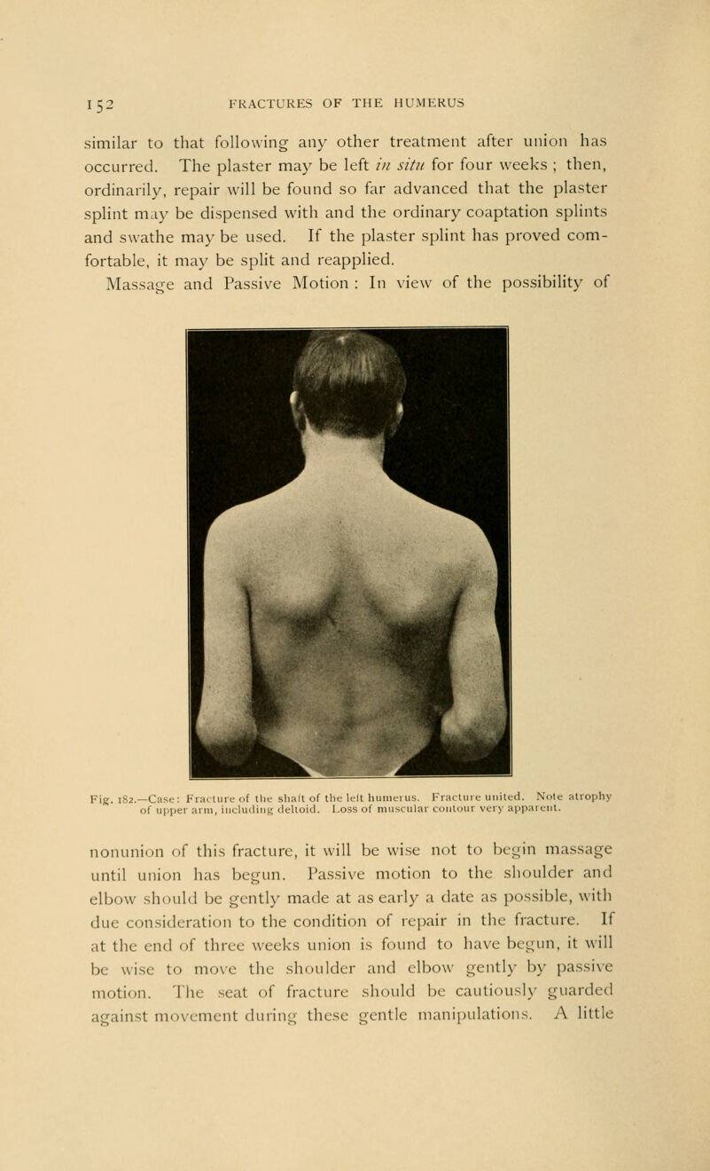 similar to that following any other treatment after union has occurred. The plaster may be left in situ for four weeks ; then, ordinarily, repair will be found so far advanced that the plaster splint may be dispensed with and the ordinary coaptation splints and swathe may be used. If the plaster splint has proved com- fortable, it may be split and reapplied. Massage and Passive Motion : In view of the possibility of Fig. 182.—Case: Fracture of tlie shalt of the left humerus. Fracture united. Note atrophy of upper arm, including deltoid. Loss of muscular contour very apparent. nonunion of this fracture, it will be wise not to begin massage until union has begun. Passive motion to the shoulder and elbow should be gently made at as early a date as possible, with due consideration to the condition of repair in the fracture. If at the end of three weeks union is found to have begun, it will be wise to move the shoulder and elbow gently by passive motion. The seat of fracture should be cautiously guarded against movement during these gentle manipulations. A little