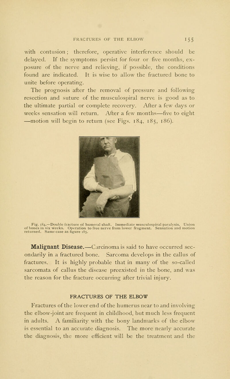with contusion ; therefore, operative interference should be delayed. If the symptoms persist for four or five months, ex- posure of the nerve and relieving, if possible, the conditions found are indicated. It is wise to allow the fractured bone to unite before operating. The prognosis after the removal of pressure and following resection and suture of the musculospiral nerve is good as to the ultimate partial or complete recovery. After a few days or weeks sensation will return. After a few months—five to eight —motion will begin to return (see Figs. 184, 185, 186). Fig. 184.—Double fracture of humeral shaft. Immediate musculospiral paralysis. Union of bones in six weeks. Operation to free nerve from lower fragment. Sensation and motion returned. Same case as figure 185. Malignant Disease.—Carcinoma is said to have occurred sec- ondarily in a fractured bone. Sarcoma develops in the callus of fractures. It is highly probable that in many of the so-called sarcomata of callus the disease preexisted in the bone, and was the reason for the fracture occurring after trivial injury. FRACTURES OF THE ELBOW Fractures of the lower end of the humerus near to and involving the elbow-joint are frequent in childhood, but much less frequent in adults. A familiarity with the bony landmarks of the elbow is essential to an accurate diagnosis. The more nearly accurate the diagnosis, the more efficient will be the treatment and the