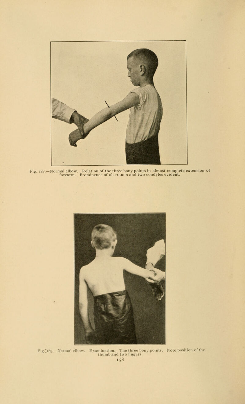 -Normal elbow. Relation of the three bony points in almost complete extension of forearm. Prominence of olecranon and two condyles evident. Normal elbow. Examination. The three bonj points thumb and two lingers. I58 Note position of the