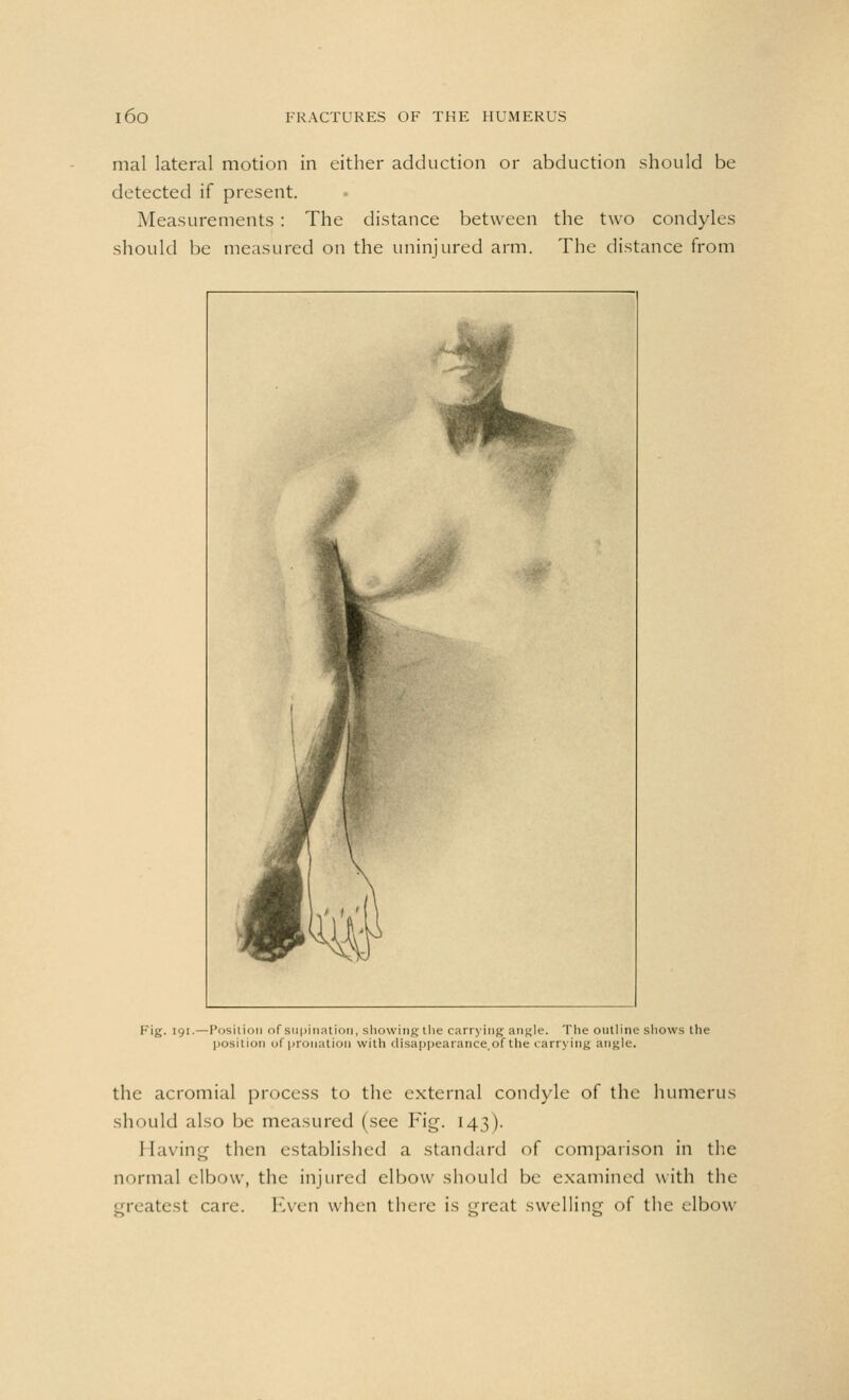 mal lateral motion in cither adduction or abduction should be detected if present. Measurements: The distance between the two condyles should be measured on the uninjured arm. The distance from Fig. 191.—Position of supination, showing the carrying angle, The outline shows the position of pronation with disappearance.of the carrying angle. the acromial process to the external condyle of the humerus should also be measured (see Fig. 143). Having then established a standard of comparison in the normal elbow, the injured elbow should be examined with the greatest care. Even when there is great swelling of the elbow