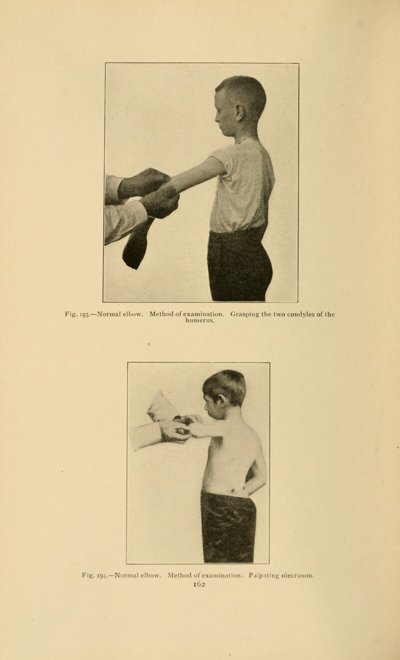Fig. 193.—Normal elbow. Method of examination. Grasping the two condyles of the humerus. Fig. 194.—Normal elbow. Method of examination. Palpating olecranon.