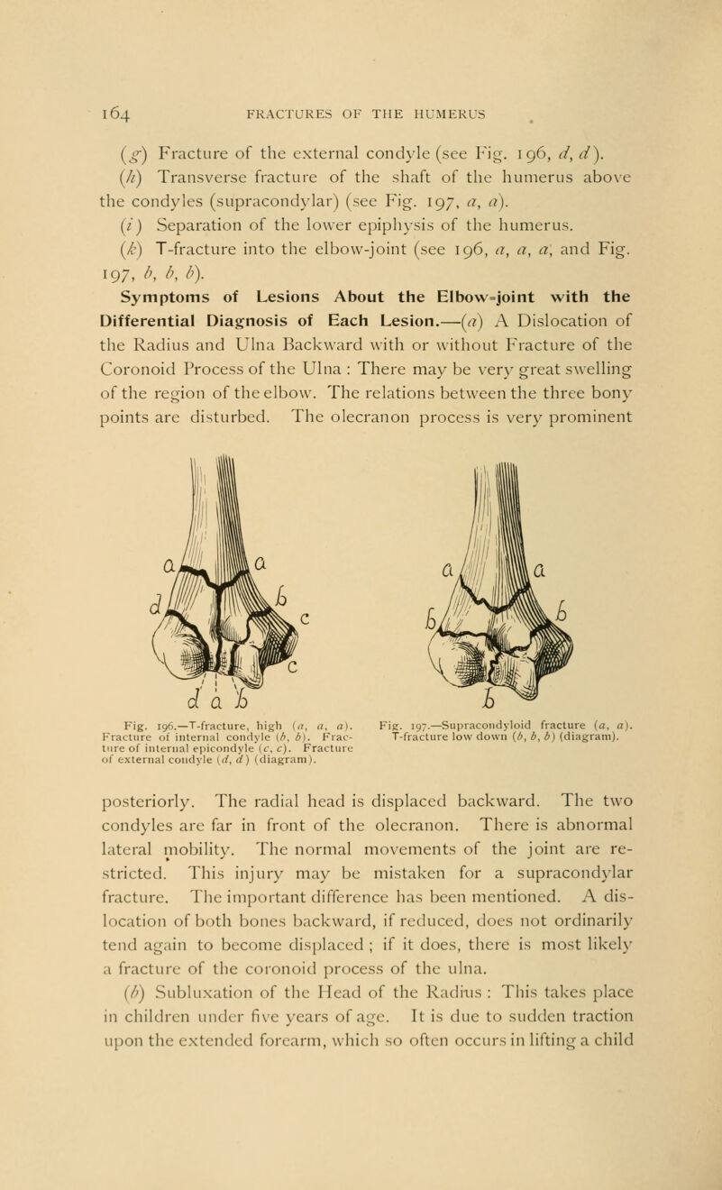 (<£) Fracture of the external condyle (see Fig. 196, d, d). (//) Transverse fracture of the shaft of the humerus above the condyles (supracondylar) (see Fig. 197, a, <?). (/') Separation of the lower epiphysis of the humerus. (/•) T-fracture into the elbow-joint (see 196, a, a, a, and Fig. 197, b, b, b). Symptoms of Lesions About the Elbow=joint with the Differential Diagnosis of Each Lesion.—(rf) A Dislocation of the Radius and Ulna Backward with or without Fracture of the Coronoid Process of the Ulna : There may be very great swelling of the region of the elbow. The relations between the three bony points are disturbed. The olecranon process is very prominent Fig. 196.—T-fracture, high (a, </, a). Fracture of internal condyle (b, b). Frac- ture of internal epicondyle (c, c). Fracture of external condyle (<i, d) (diagram). Fig. 197.—Supracoudyloid fracture (a, a). T-fracture low down (b, b, b) (diagram). posteriorly. The radial head is displaced backward. The two condyles are far in front of the olecranon. There is abnormal Literal mobility. The normal movements of the joint are re- stricted. This injury may be mistaken for a supracondylar fracture. The important difference has been mentioned. A dis- location of both bones backward, if reduced, does not ordinarily tend again to become displaced ; if it does, there is most likely a fracture of the coronoid process of the ulna. (/;) Subluxation of the Head of the Radius : This takes place in children under five years of age. It is due to sudden traction upon the extended forearm, which so often occurs in lifting a child