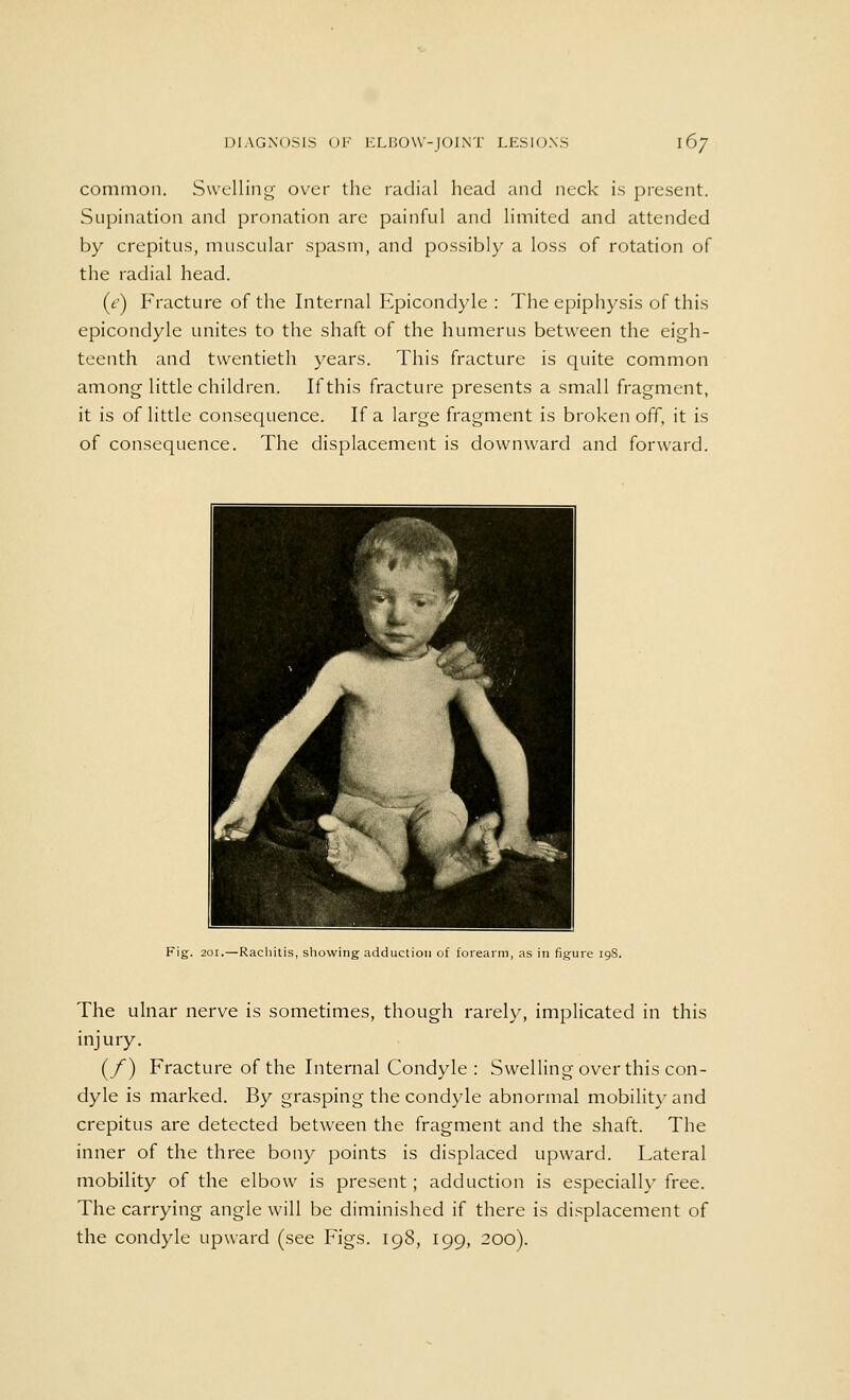 common. Swelling over the radial head and neck is present. Supination and pronation are painful and limited and attended by crepitus, muscular spasm, and possibly a loss of rotation of the radial head. (v) Fracture of the Internal Epicondyle : The epiphysis of this epicondyle unites to the shaft of the humerus between the eigh- teenth and twentieth years. This fracture is quite common among little children. If this fracture presents a small fragment, it is of little consequence. If a large fragment is broken off, it is of consequence. The displacement is downward and forward. Fig. 201.—Rachitis, showing adduction of forearm, as in figure 15 The ulnar nerve is sometimes, though rarely, implicated in this injury. (/) Fracture of the Internal Condyle : Swelling over this con- dyle is marked. By grasping the condyle abnormal mobility and crepitus are detected between the fragment and the shaft. The inner of the three bony points is displaced upward. Lateral mobility of the elbow is present; adduction is especially free. The carrying angle will be diminished if there is displacement of the condyle upward (see Figs. 198, 199, 200).