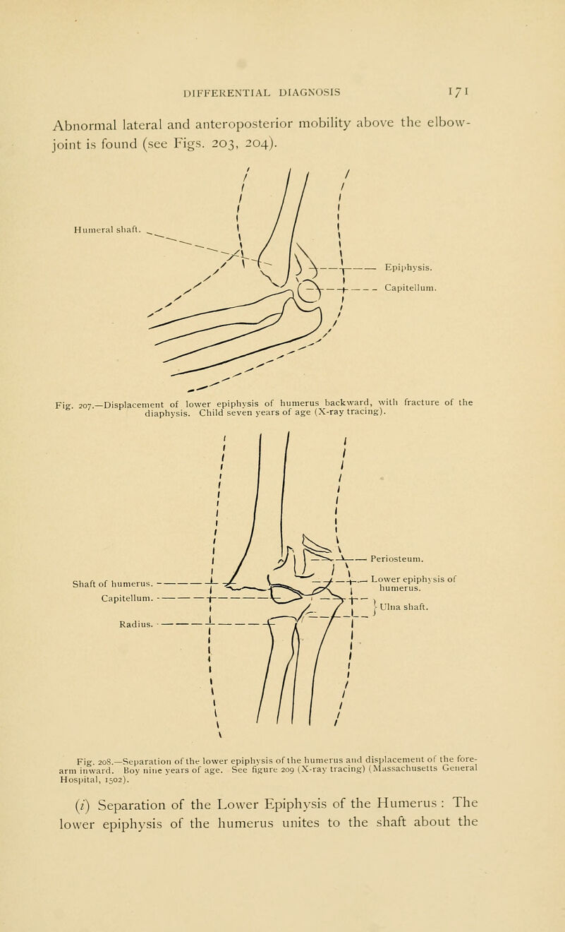 Abnormal lateral and anteroposterior mobility above the elbow- joint is found (see Figs. 203, 204). Humeral shaft. . Epiphysis. Capitellum. pjo- 207—Displacement of lower epiphysis of humerus backward, with fracture of the diaphysis. Child seven years of age (X-ray tracing). Shaft of humerus. - Capitellum. -- Radius. enosteum. ower epiphysis of humerus. [ Ulna shaft. Fig. 208.—Separation of the lower epiphysis of the humerus and displacement of the fore- arm inward. Boy nine years of age. See figure 209 (X-ray tracing) (Massachusetts General Hospital, 1502). (/) Separation of the Lower Epiphysis of the Humerus : The lower epiphysis of the humerus unites to the shaft about the