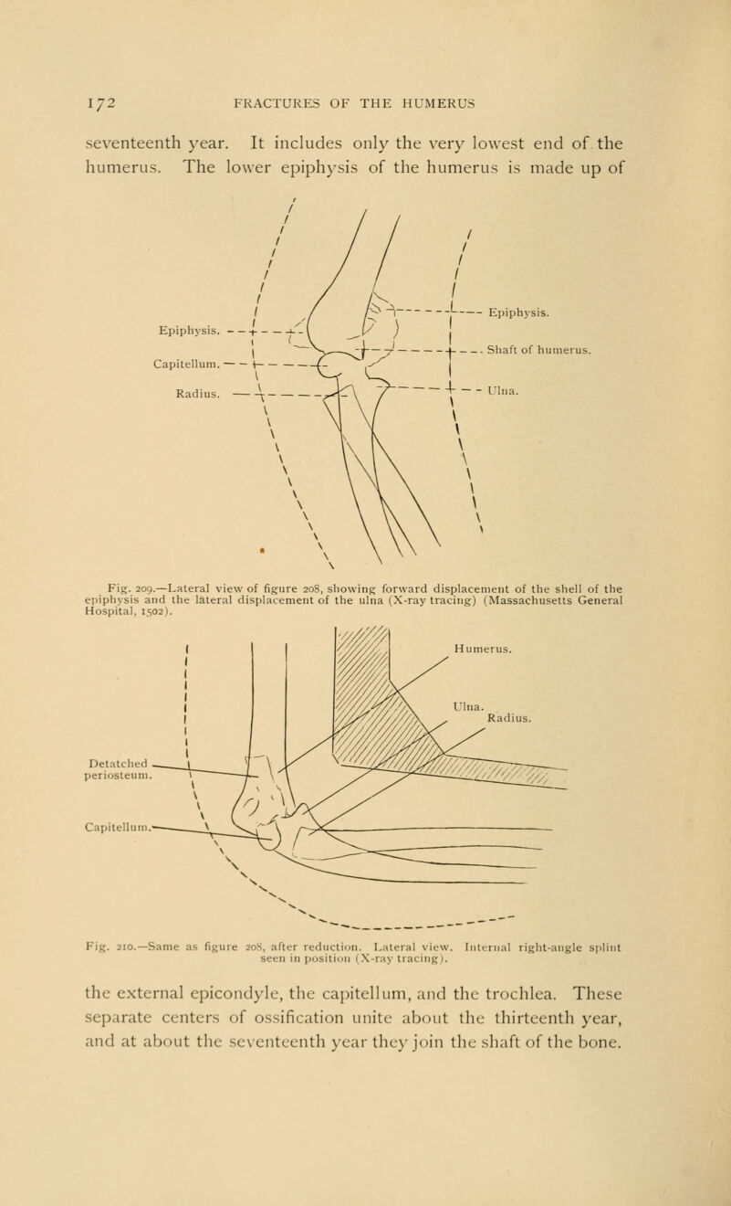 seventeenth year. It includes only the very lowest end of the humerus. The lower epiphysis of the humerus is made up of Epiphysis. 1- Capitellum. Radius. ^ Epiphysis. Shaft of humerus. Ulna. Fig. 209.—Lateral view of figure 208, showing forward displacement of the shell of the epiphysis and the lateral displacement of the ulna (X-ray tracing) (Massachusetts General Hospital, 1502). Capitellum. Fig. 210.—Same as figure 208, after reduction. Lateral view. Internal right-angle splint seen in position (X-ray tracing). the external epicondyle, the capitellum, and the trochlea. These separate centers of ossification unite about the thirteenth year, and at about the seventeenth year they join the shaft of the bone.
