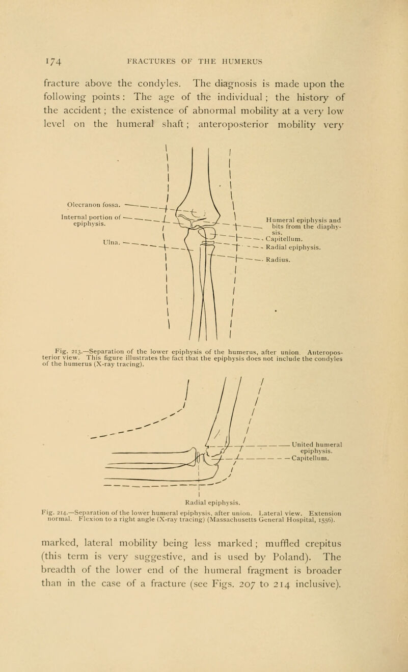fracture above the condyles. The diagnosis is made upon the following points : The age of the individual ; the history of the accident; the existence of abnormal mobility at a very low level on the humeral shaft; anteroposterior mobility very Olecranon fossa. Interna] portion of epiphysis. Ulna. — -— __ Humeral epiphysis and —. bits from the diaphy- sis. — - Capitellnm. — - Radial epiphysis. — Radius. Fig. 213.—Separation of the lower epiphysis of the humerus, after union. Anteropos- terior view. This figure illustrates the fact that the epiphysis does not include the condyles of the humerus (X-ray tracing). Z3fcf+- United humeral epiphysis. Capitellnm. 1 1 Radial epiphysis. Fig. 214.—Separation of the lower humeral epiphysis, after union. Lateral view. Extension normal. Flexion to a right angle (X-ray tracing) (Massachusetts General Hospital, 1556). marked, lateral mobility being less marked ; muffled crepitus (this term is very suggestive, and is used by Poland). The breadth of the lower end of the humeral fragment is broader than in the case of a fracture (see Figs. 207 to 214 inclusive).