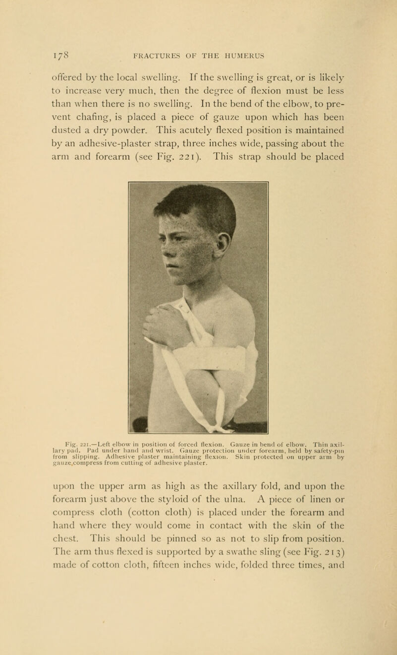 offered by the local swelling. If the swelling is great, or is likely to increase very much, then the degree of flexion must be less than when there is no swelling. In the bend of the elbow, to pre- vent chafing, is placed a piece of gauze upon which has been dusted a dry powder. This acutely flexed position is maintained by an adhesive-plaster strap, three inches wide, passing about the arm and forearm (see Fig. 221). This strap should be placed Fig. 221.—Left elbow in position of forced flexion. Gauze in bend of elbow. Thin axil- lary pad. Pad under band and wrist. Gauze protection under forearm, held by safety-pin from slipping. Adhesive plaster maintaining flexion. Skin protected on upper arm by gauze.compress from cutting of adhesive plaster. upon the upper arm as high as the axillary fold, and upon the forearm just above the styloid of the ulna. A piece of linen or compress cloth (cotton cloth) is placed under the forearm and hand where they would come in contact with the skin of the (lust. This should be pinned so as not to slip from position. The arm thus flexed is supported by a swathe sling (see Fig. 213) made of cotton cloth, fifteen inches wide, folded three times, and