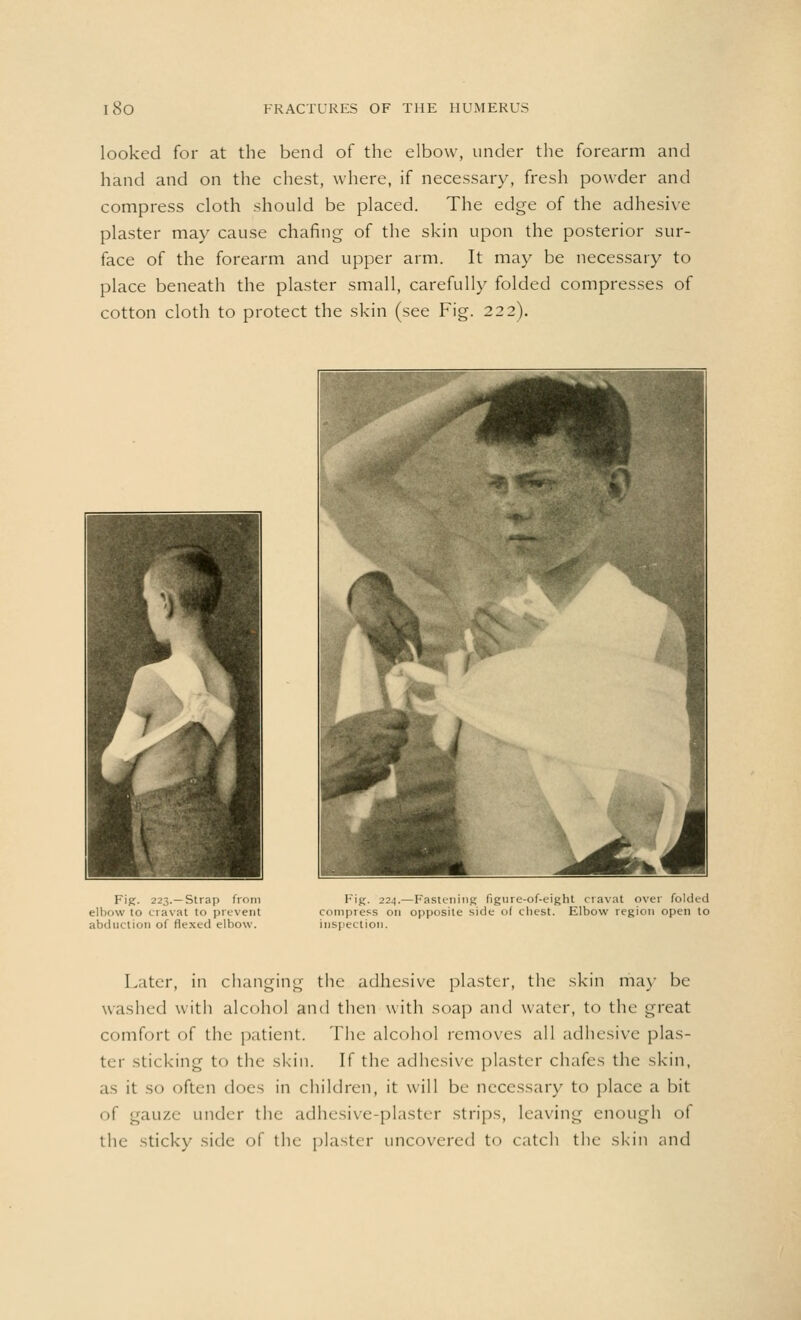 looked for at the bend of the elbow, under the forearm and hand and on the chest, where, if necessary, fresh powder and compress cloth should be placed. The edge of the adhesive plaster may cause chafing of the skin upon the posterior sur- face of the forearm and upper arm. It may be necessary to place beneath the plaster small, carefully folded compresses of cotton cloth to protect the skin (see Fig. 222). Fig. 223.—Strap from elbow to cravat to prevent abduction of flexed elbow. Fig. 224.—Fastening figure-of-eight cravat over folded Compress on opposite side of chest. Elbow region open to inspection. Later, in changing the adhesive plaster, the skin may be washed with alcohol and then with soap and water, to the great comfort of the patient. The alcohol removes all adhesive plas- ter sticking to the skin. If the adhesive plaster chafes the skin, as it so often docs in children, it will be necessary to place a bit of gauze under the adhesive plaster strips, leaving enough of the sticky side of the plaster uncovered to catch the skin and