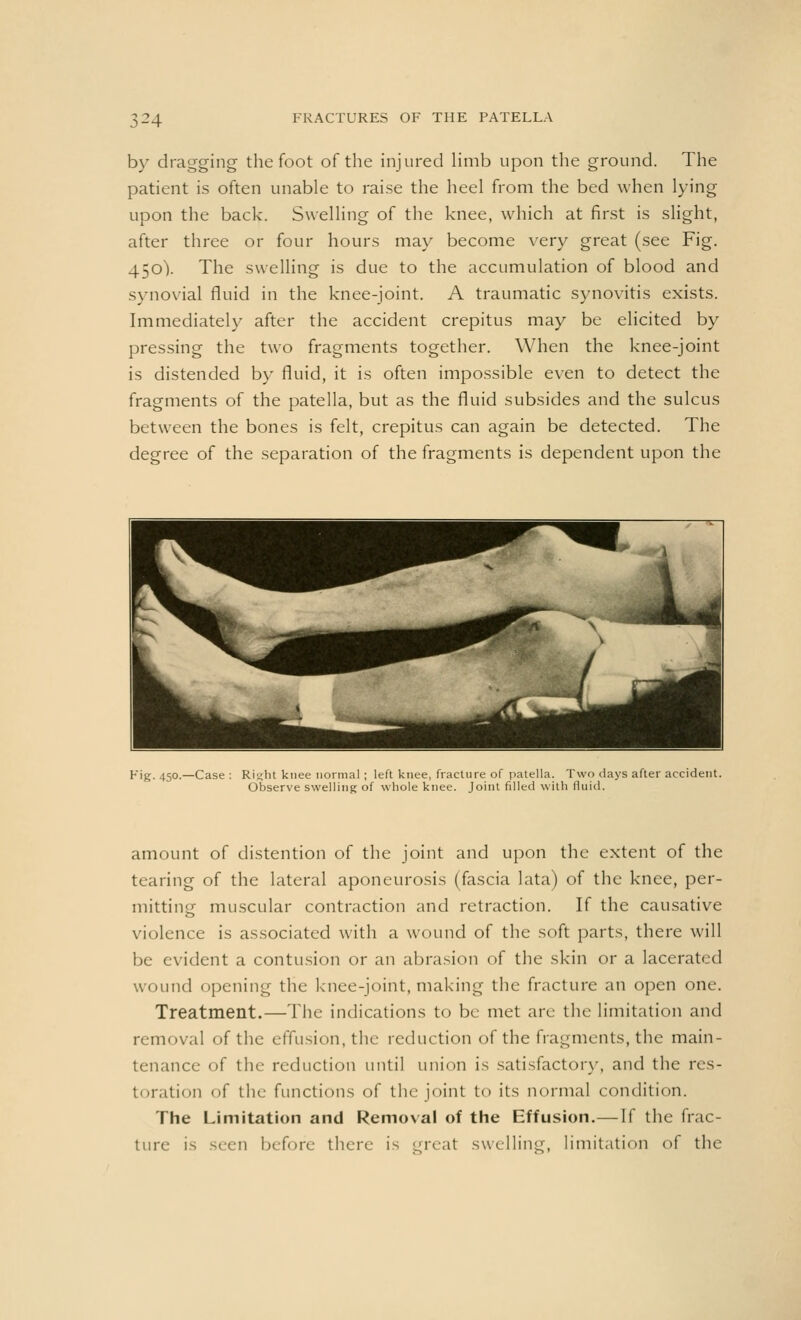 by dragging the foot of the injured limb upon the ground. The patient is often unable to raise the heel from the bed when lying upon the back. Swelling of the knee, which at first is slight, after three or four hours may become very great (see Fig. 450). The swelling is due to the accumulation of blood and synovial fluid in the knee-joint. A traumatic synovitis exists. Immediately after the accident crepitus may be elicited by pressing the two fragments together. When the knee-joint is distended by fluid, it is often impossible even to detect the fragments of the patella, but as the fluid subsides and the sulcus between the bones is felt, crepitus can again be detected. The degree of the separation of the fragments is dependent upon the Fig. 450.—Case : Ri^ht knee normal; left knee, fracture of patella. Two days after accident. Observe swelling of whole knee. Joint filled with fluid. amount of distention of the joint and upon the extent of the tearing of the lateral aponeurosis (fascia lata) of the knee, per- mitting muscular contraction and retraction. If the causative violence is associated with a wound of the soft parts, there will be evident a contusion or an abrasion of the skin or a lacerated wound opening the knee-joint, making the fracture an open one. Treatment.—The indications to be met arc the limitation and removal of the effusion, the reduction of the fragments, the main- tenance of the reduction until union is satisfactory, and the res- toration of the functions of the joint to its normal condition. The Limitation and Removal of the Effusion.— If the frac- ture is seen before: there is great swelling, limitation of the