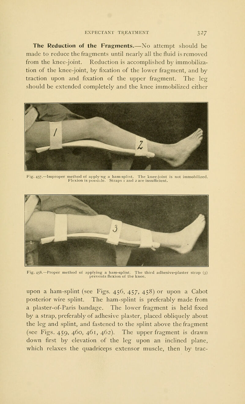 The Reduction of the Fragments.—No attempt should be made to reduce the fragments until nearly all the fluid is removed from the knee-joint. Reduction is accomplished by immobiliza- tion of the knee-joint, by fixation of the lower fragment, and by traction upon and fixation of the upper fragment. The leg should be extended completely and the knee immobilized either Fig. 457.—Improper method of applyng a ham-splint. The knee-joint is not immobilized. Flexion is possible. Straps 1 and 2 are insufficient. Fig. 458.—Proper method of applying a ham-splint. The third adhesive-plaster strap (3) prevents flexion of the knee. upon a ham-splint (see Figs. 456, 457, 458) or upon a Cabot posterior wire splint. The ham-splint is preferably made from a plaster-of-Paris bandage. The lower fragment is held fixed by a strap, preferably of adhesive plaster, placed obliquely about the leg and splint, and fastened to the splint above the fragment (see Figs. 459, 460, 461, 462). The upper fragment is drawn down first by elevation of the leg upon an inclined plane, which relaxes the quadriceps extensor muscle, then by trac-