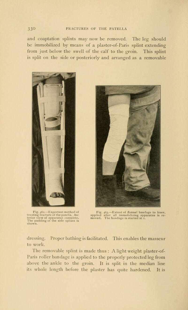 and coaptation splints may now be removed. The leg should be immobilized by means of a plaster-of-Paris splint extending from just below the swell of the calf to the groin. This splint is split on the side or posteriorly and arranged as a removable Fig. 462.—Expectant method of treating fracture of the patella. An- terior view 01 apparatus complete. The padding of the side splints is shown. Fig. 463.—Extent of flannel bandage to knee, applied after all immobilizing apparatus is re- moved. The bandage is started at I. dressing. Proper bathing is facilitated. This enables the masseur to work. The removable splint is made thus : A light weight plaster-of- Paris roller bandage is applied to the properly protected leg from above the ankle to the groin. It is split in the median line its whole length before the plaster has quite hardened. It is