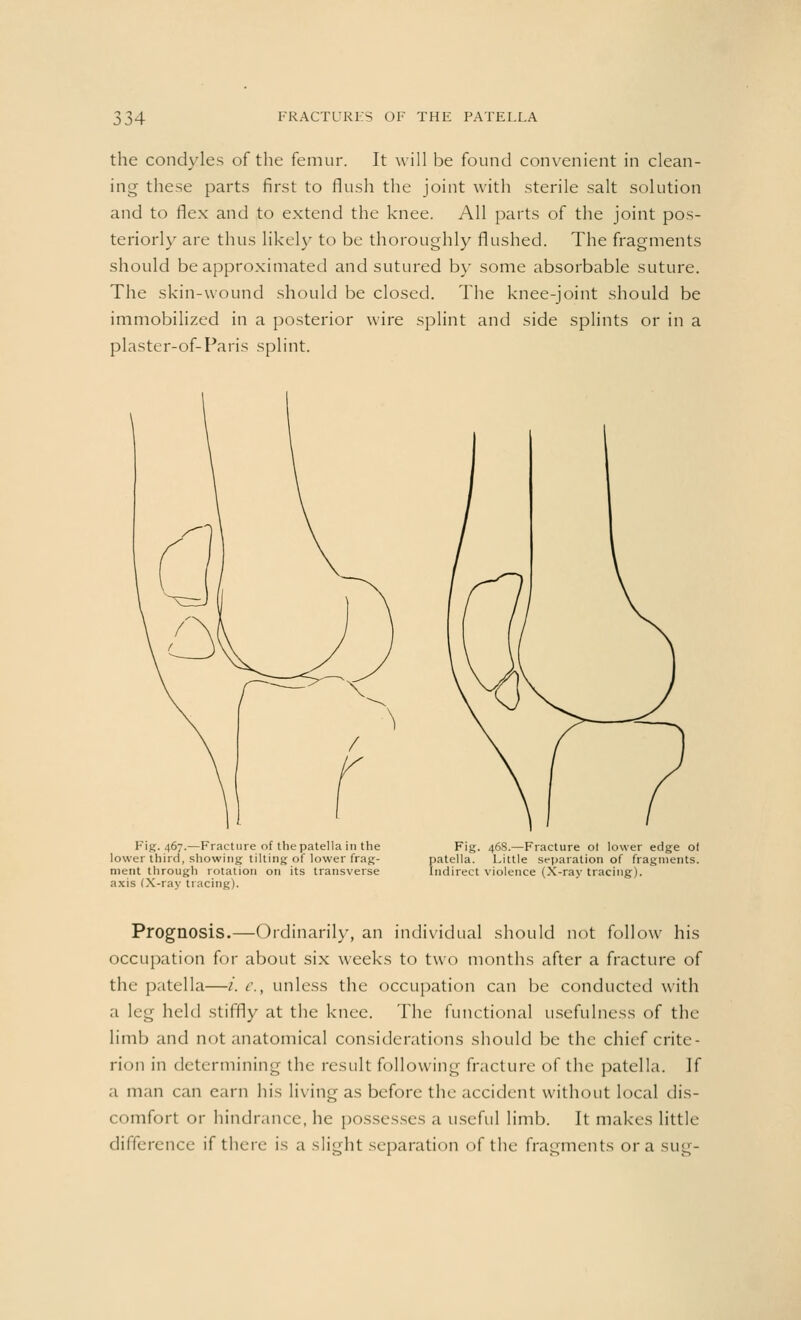 the condyles of the femur. It will be found convenient in clean- ing these parts first to flush the joint with sterile salt solution and to flex and to extend the knee. All parts of the joint pos- teriorly are thus likely to be thoroughly flushed. The fragments should be approximated and sutured by some absorbable suture. The skin-wound should be closed. The knee-joint should be immobilized in a posterior wire splint and side splints or in a plaster-of-Paris splint. Fig. 467.—Fracture of the patella in the lower third, showing tilting of lower frag- ment through rotation on its transverse axis (X-ray tracing). Fig. 468.—Fracture ot lower edge of patella. Little separation of fragments. Indirect violence (X-ray tracing). Prognosis.—Ordinarily, an individual should not follow his occupation for about six weeks to two months after a fracture of the patella—/. e., unless the occupation can be conducted with a leg held stiffly at the knee. The functional usefulness of the limb and not anatomical considerations should be the chief crite- rion in determining the result following fracture of the patella. If a man can earn his living as before the accident without local dis- comfort or hindrance, he possesses a useful limb. It makes little difference if there is a slight separation of the fragments or a sug-
